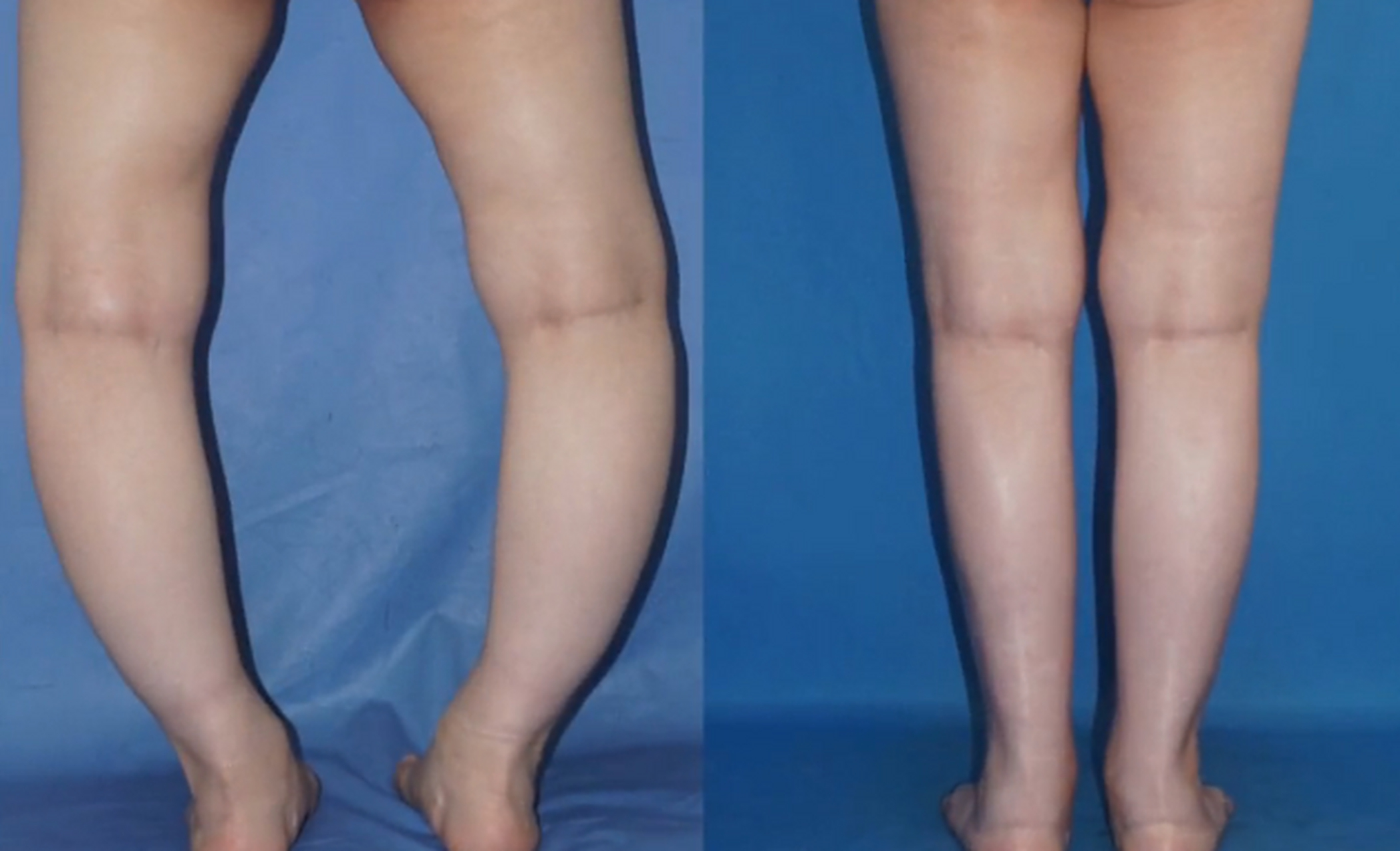 来我这看关节炎的,很多是年轻时候0型腿,x型腿,膝外翻,膝内翻没有治疗