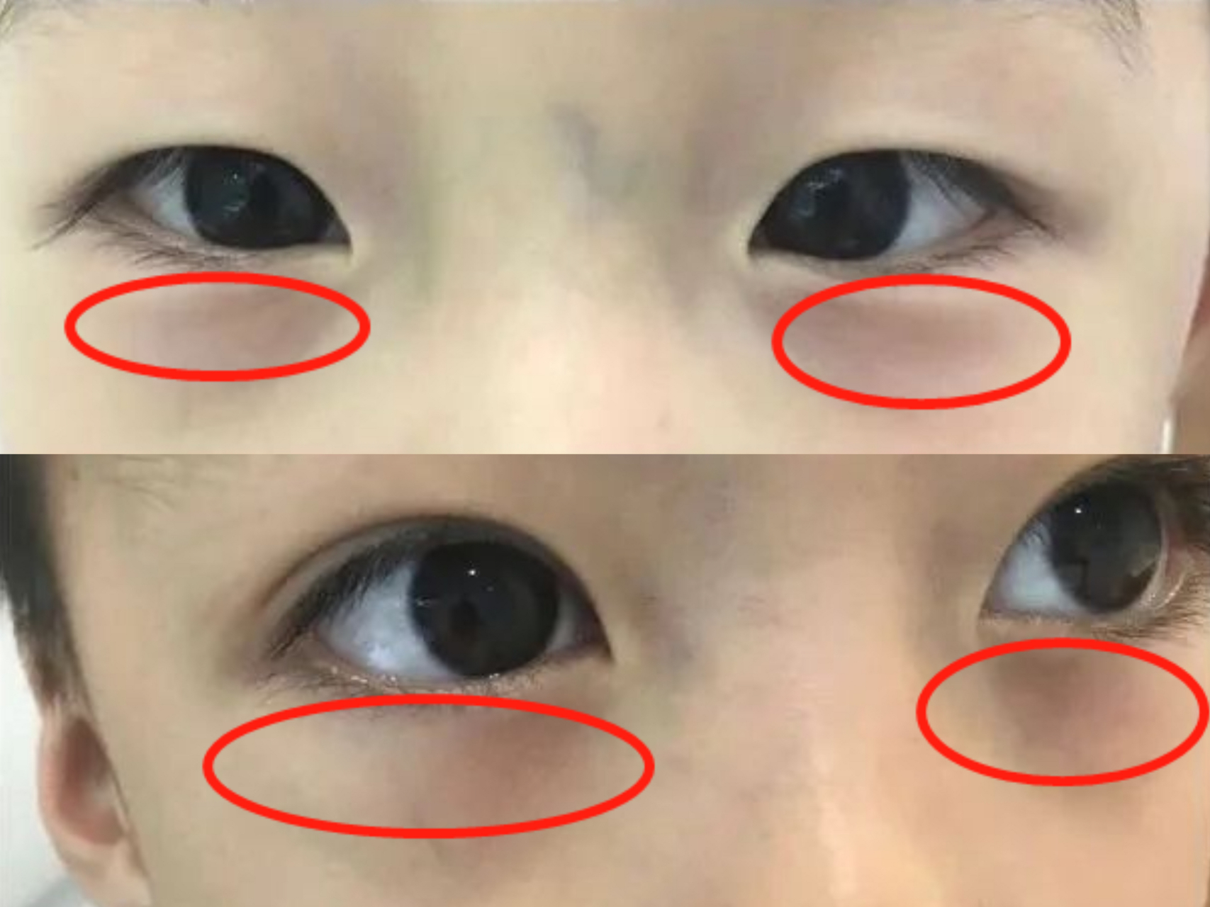 近期有很多家长留言说自家孩子积食,食欲差,眼睑发青,面色萎黄,伯爱