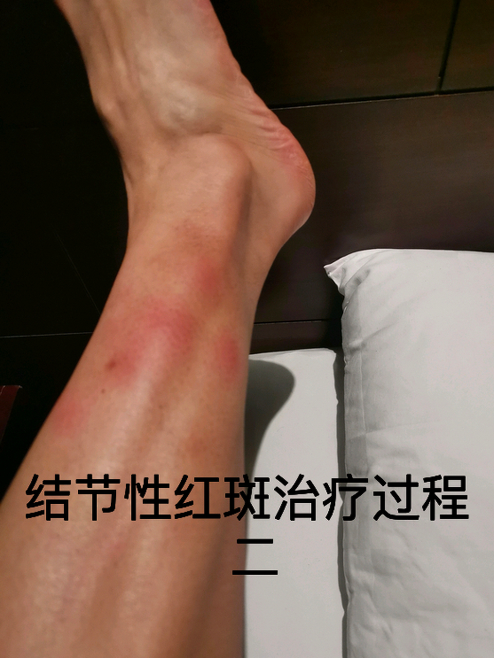 结节性红斑治疗过程 二 #结节性红斑# #疾病治疗经验# #健康经验笔记