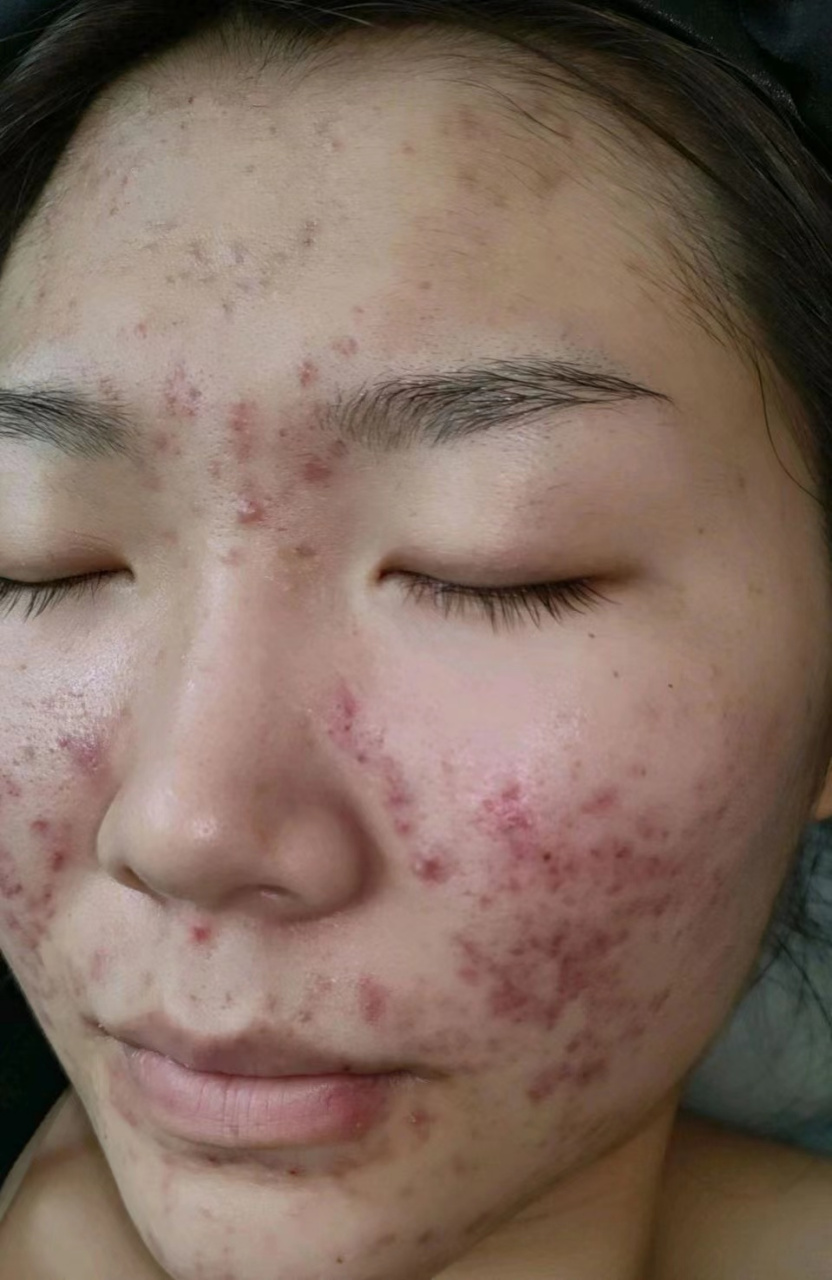 "女孩子满脸长痘还怎么出去见人啊" 这是一位患者见到我说的第一句话