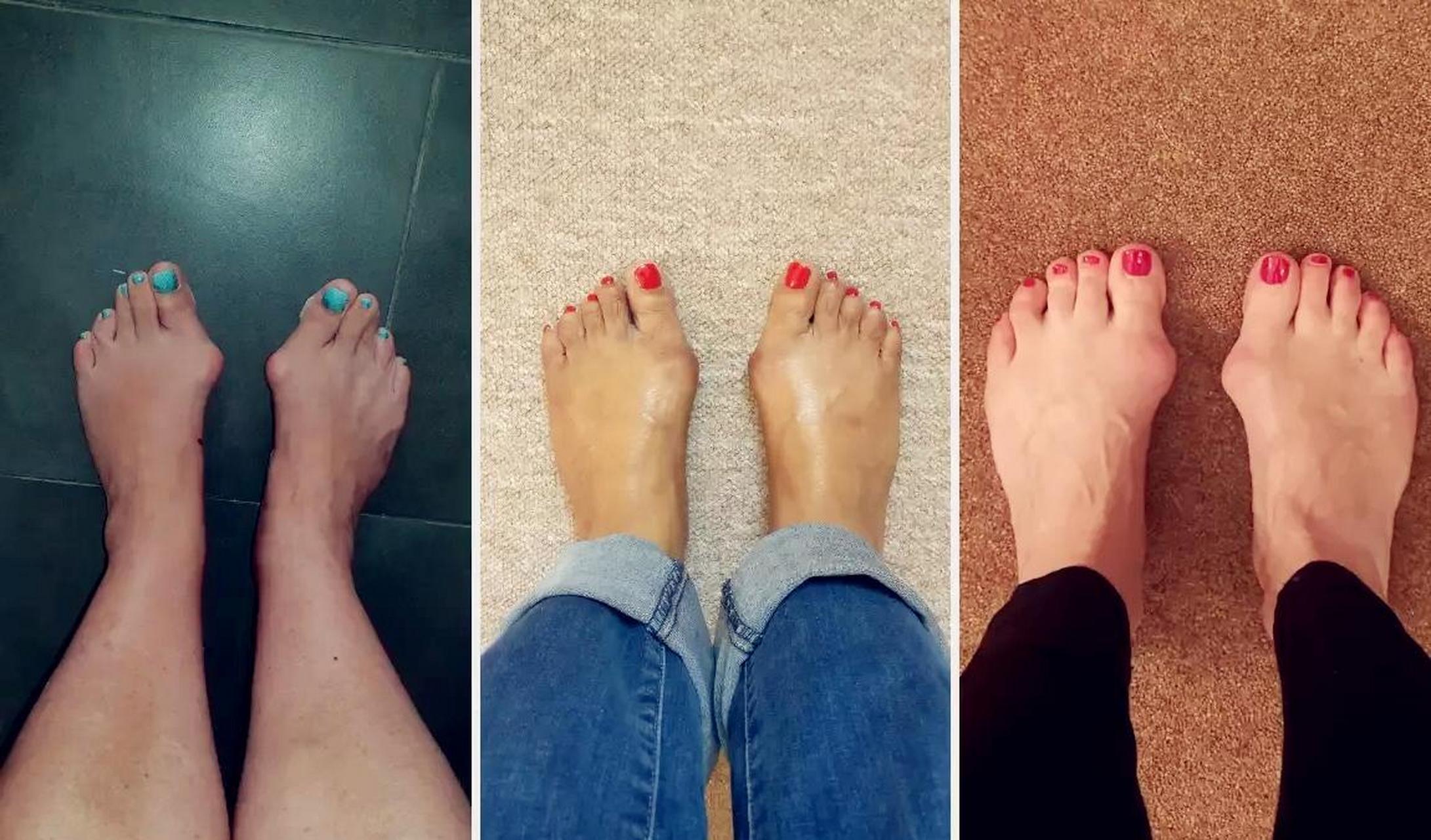 经常穿高跟鞋的女性,更容易出现以下脚型