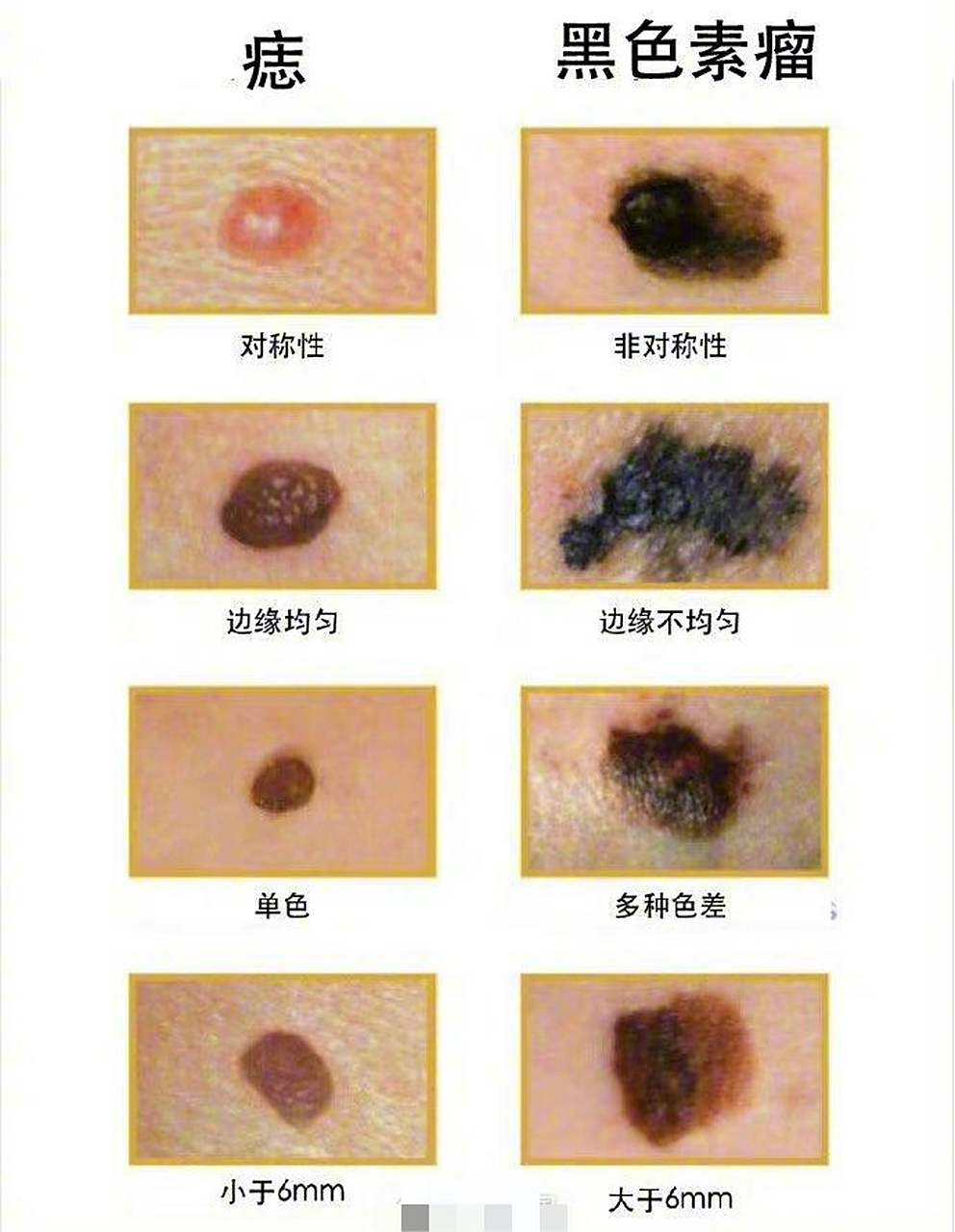 色素痣# 可见于任何正常人体,有的在出生时就已存在,有的在出生后