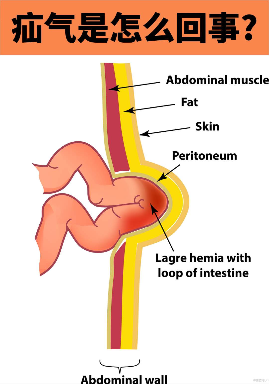 嵌顿疝腹股沟疝图片