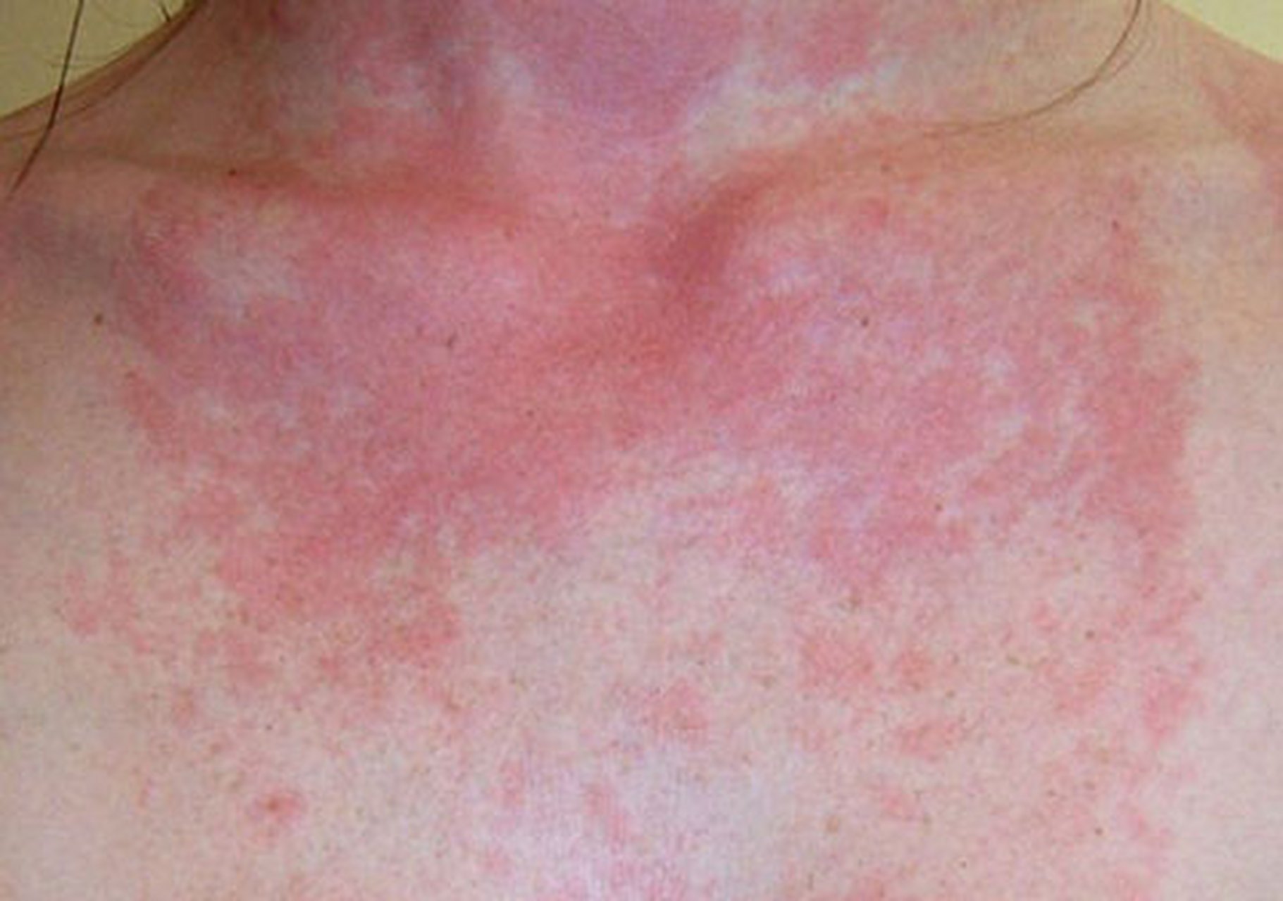 光敏性皮炎# #皮肤病# 光敏性皮炎主要是由于患者皮肤对太阳光产生