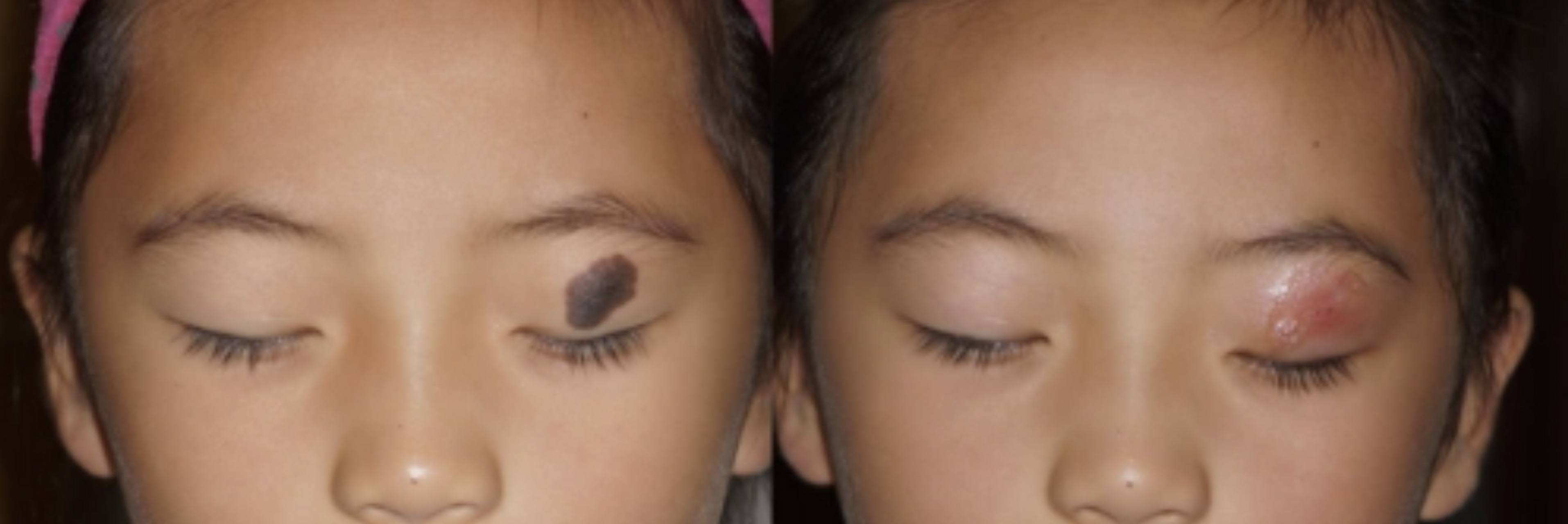 【身上长了色素痣,有必要切除吗?