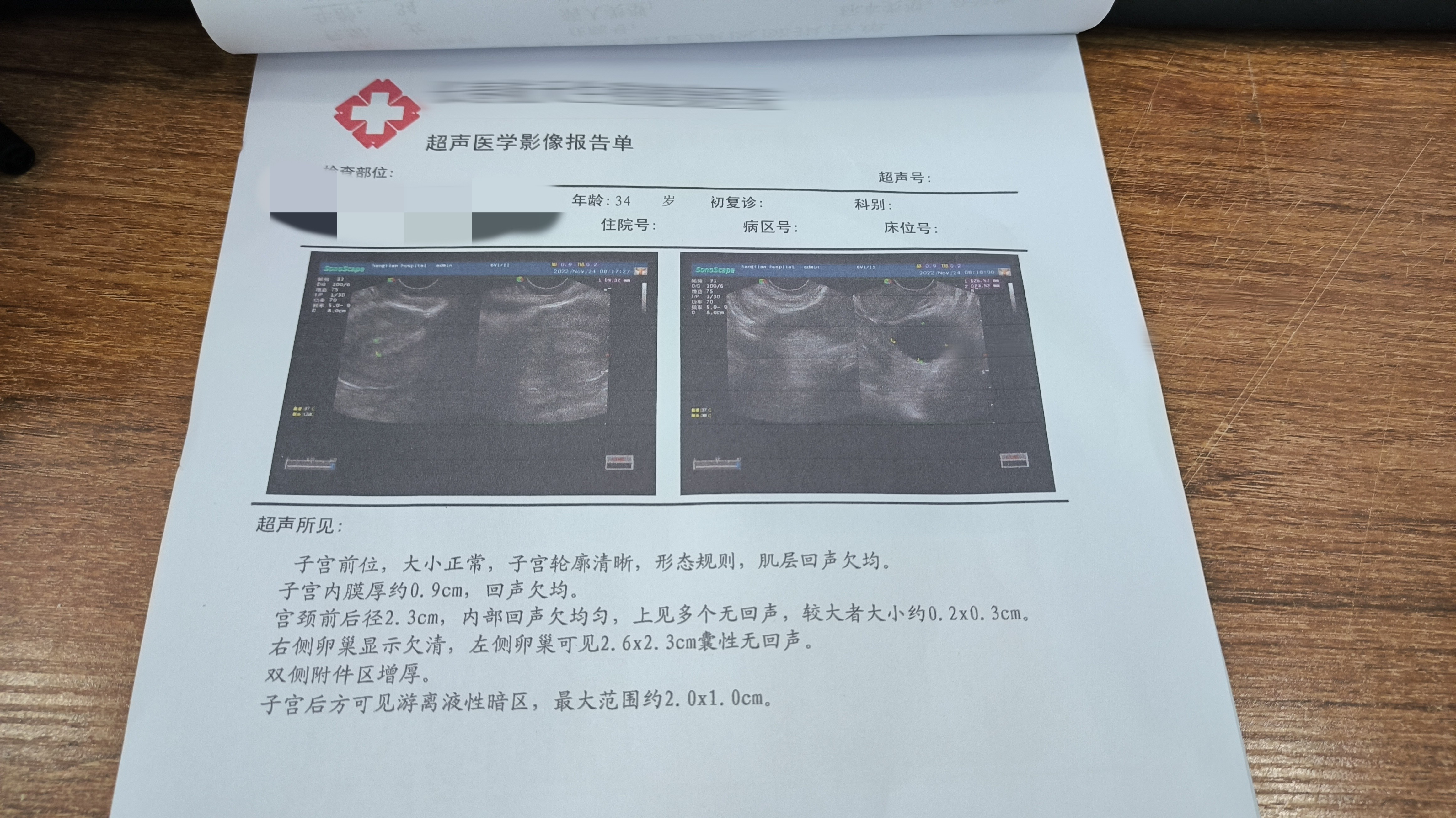 宫颈囊肿是女性非常常见的疾病,它没什么明显的症状,一般只能在检查中