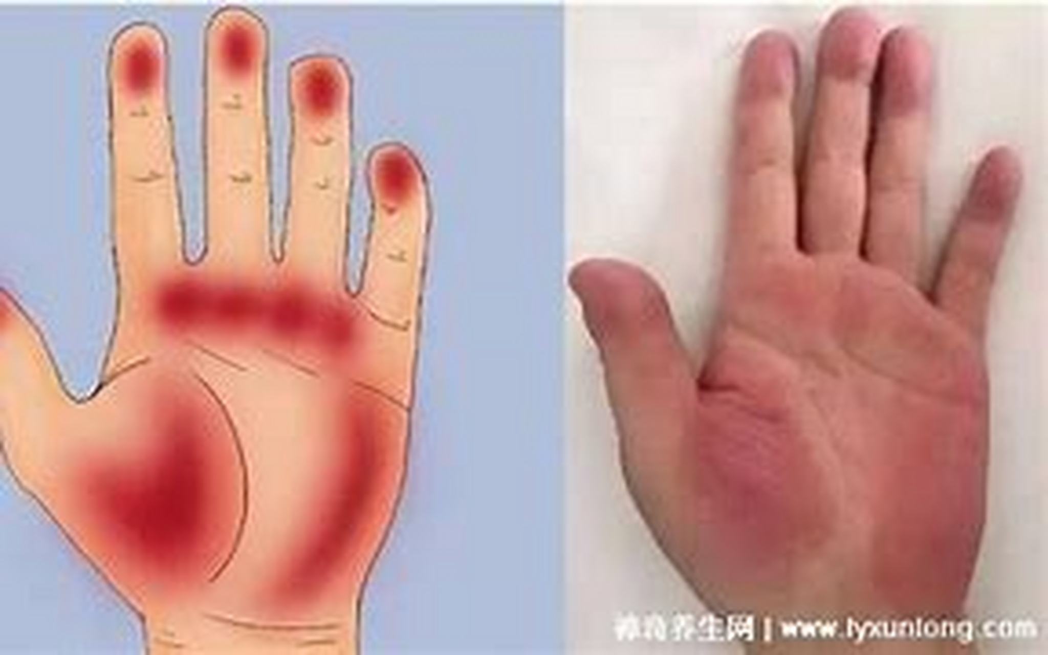 手掌发红并不一定就是肝掌,因为手掌发红可能由多种原因引起,包括