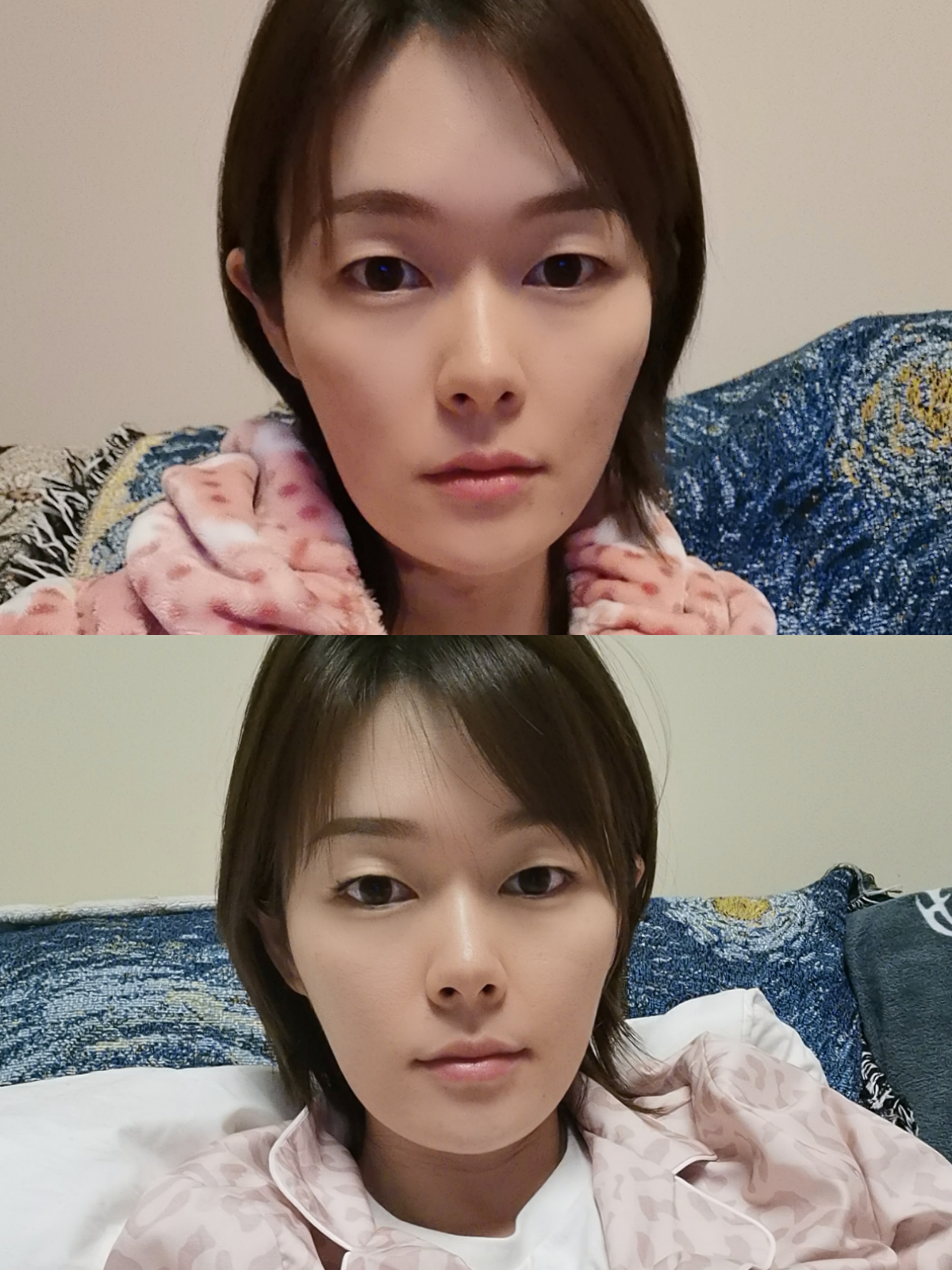 fotona4d pro 真的能刺激胶原蛋白再生吗?