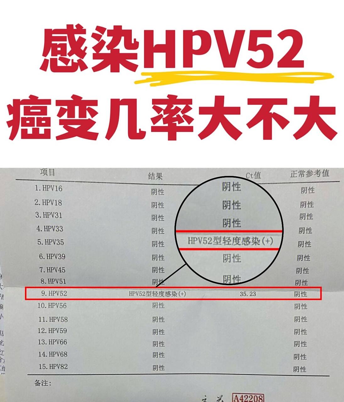 感染hpv52,癌变几率大不大?