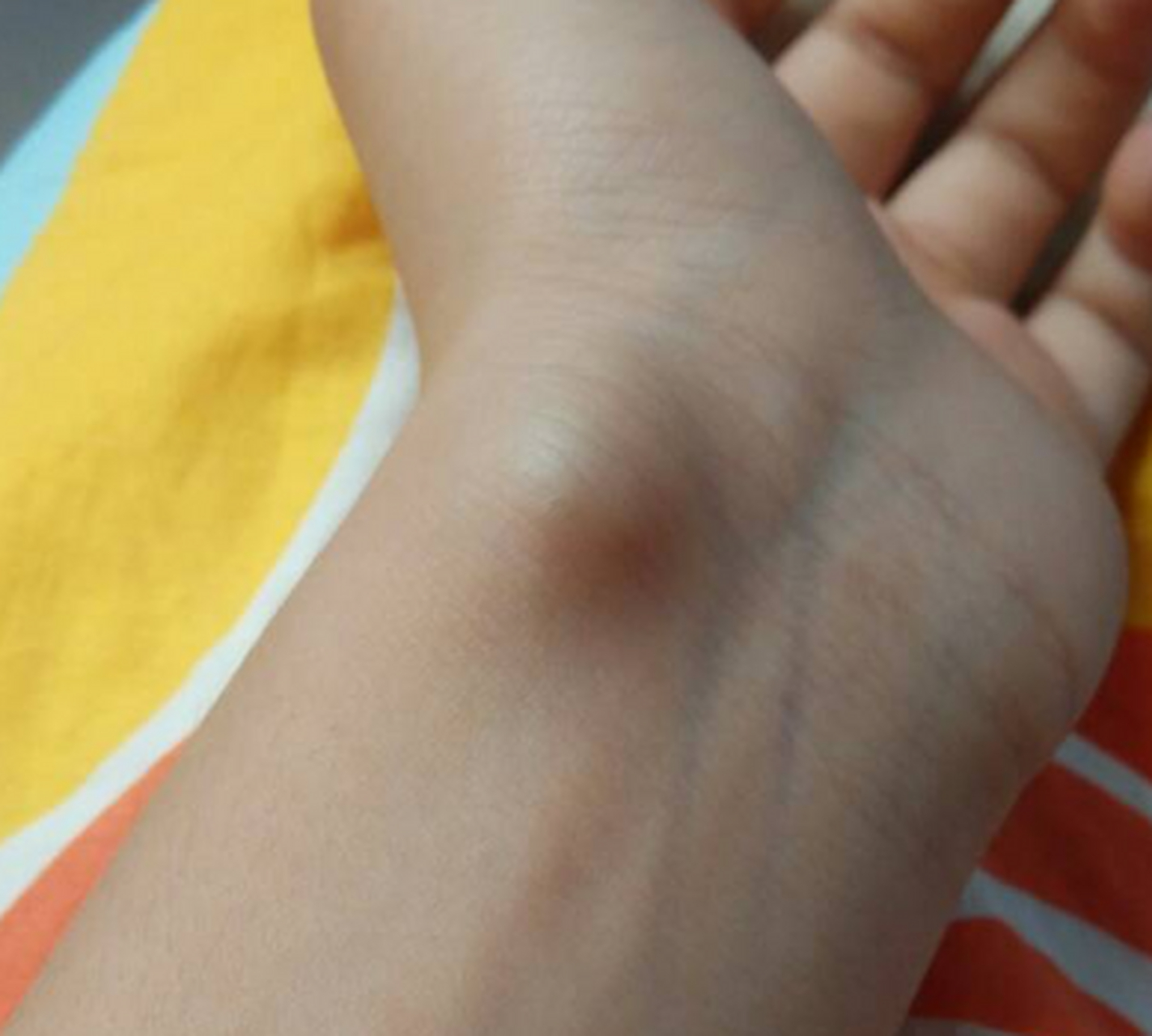 我手腕上长了个肿包,去检查时医生说是腱鞘囊肿,一使劲就给我按破了