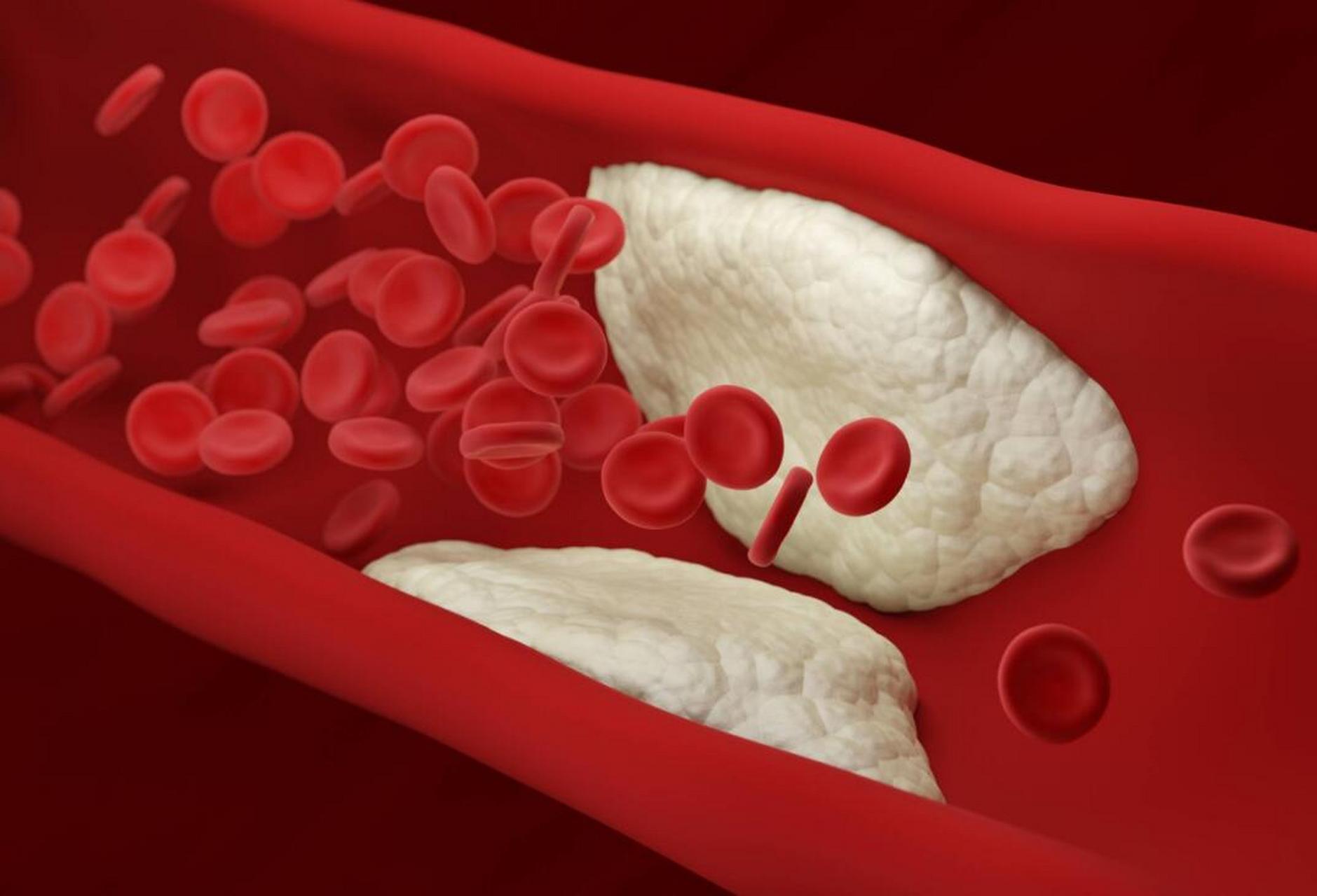 双侧颈动脉多发斑块 血压偏高,中医都可以解决 63岁的程女士,2年前