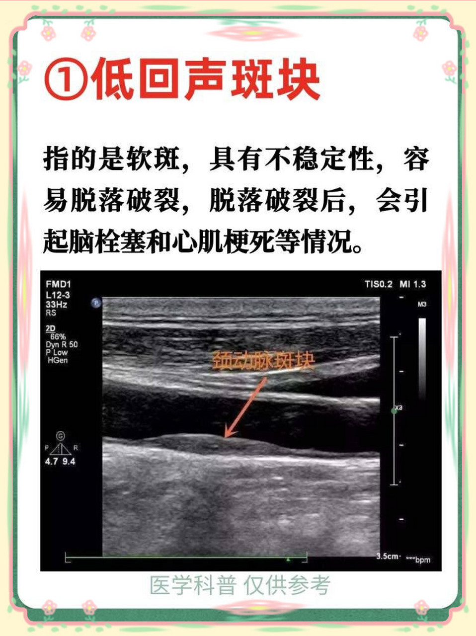 颈动脉斑块超声图片