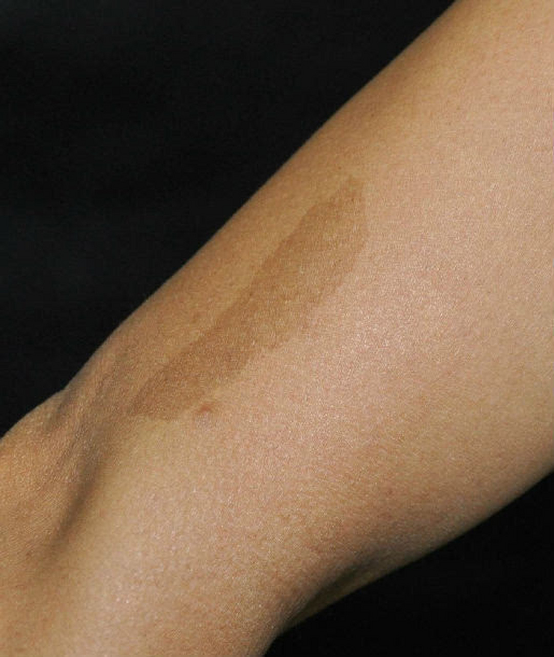 如果身上有发现咖啡斑,注意一下这个疾病  标准:青春期前6个或6个以上