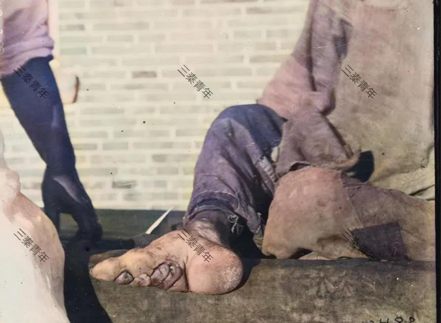 时期,该时期的一名女性在面对镜头时向观众展示了她缠足后变形的脚部