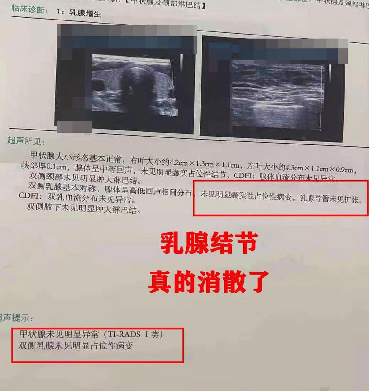 一个乳腺结节3类患者的自述! 一年前,我检查出了乳腺结节,大小是1.6*1