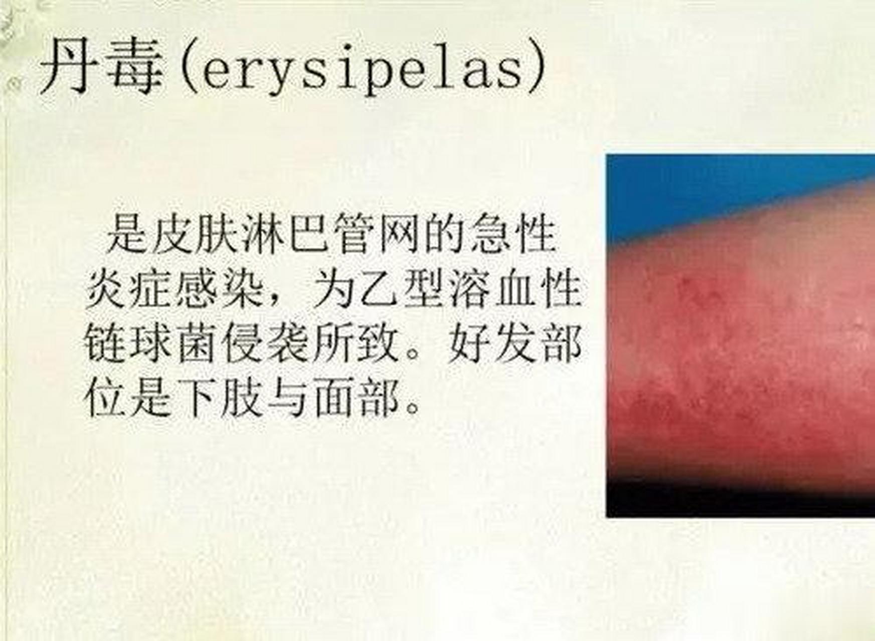 "丹毒":中医病症名称.