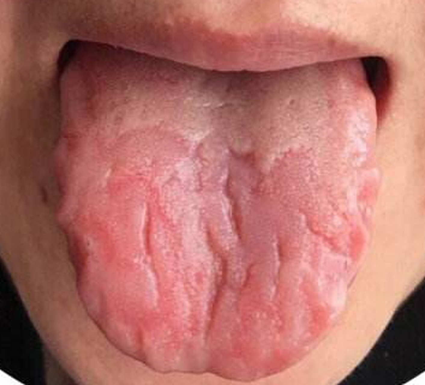 医院常用的舌头裂纹内治方,赶快收藏起来.