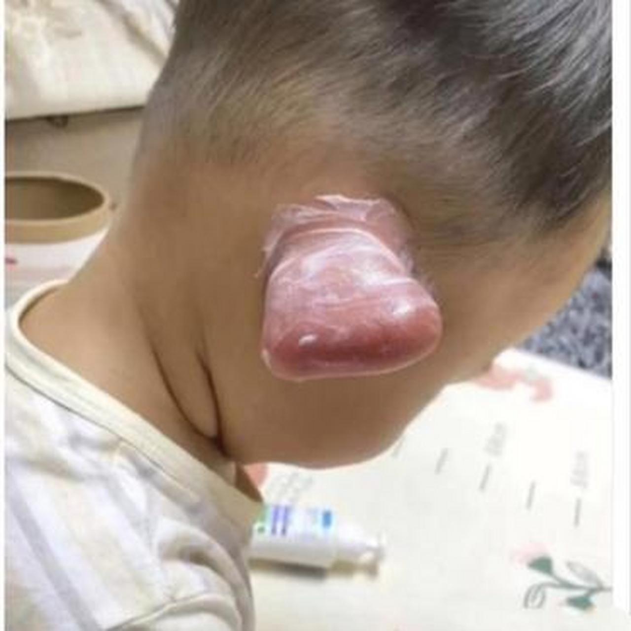 小侄子被蚊子咬了耳朵,成了顺风耳,看着好可爱