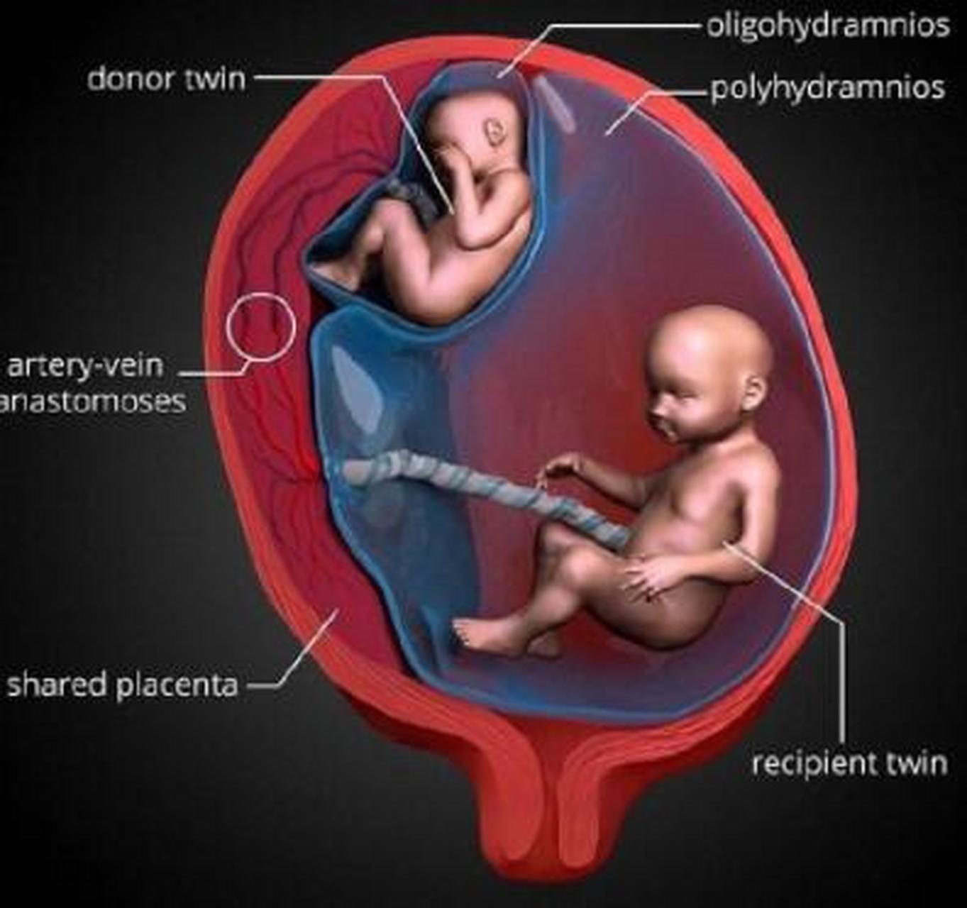 双胎输血综合征】  简单理解即共用一个胎盘的双胞胎,2个胎宝在娘肚子