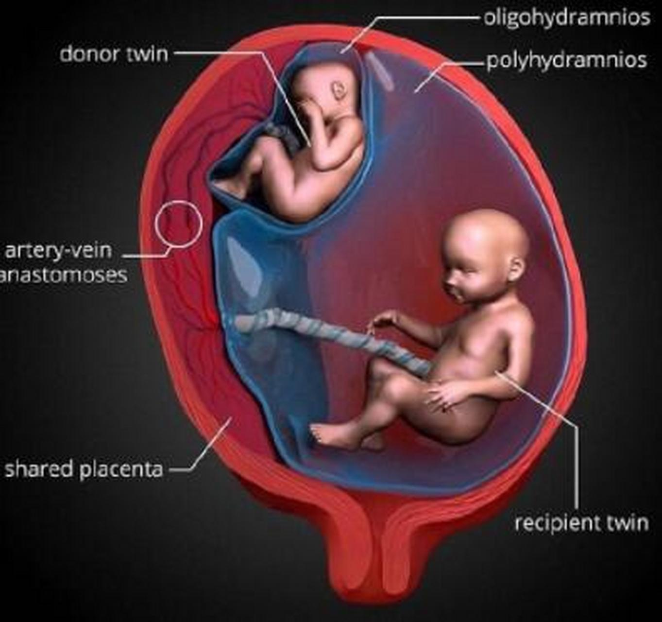 胎盘图片双胞胎图片