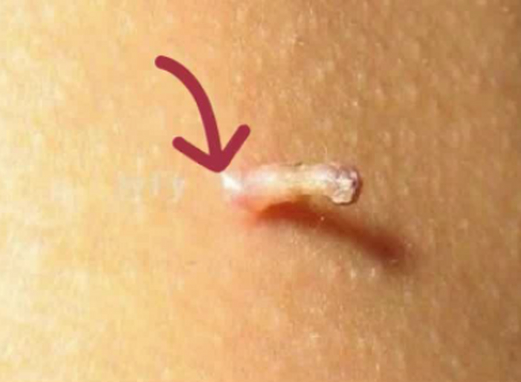 见图,这种疣叫丝状疣,是感染低危型hpv引起的,生活中有很多人用手抠