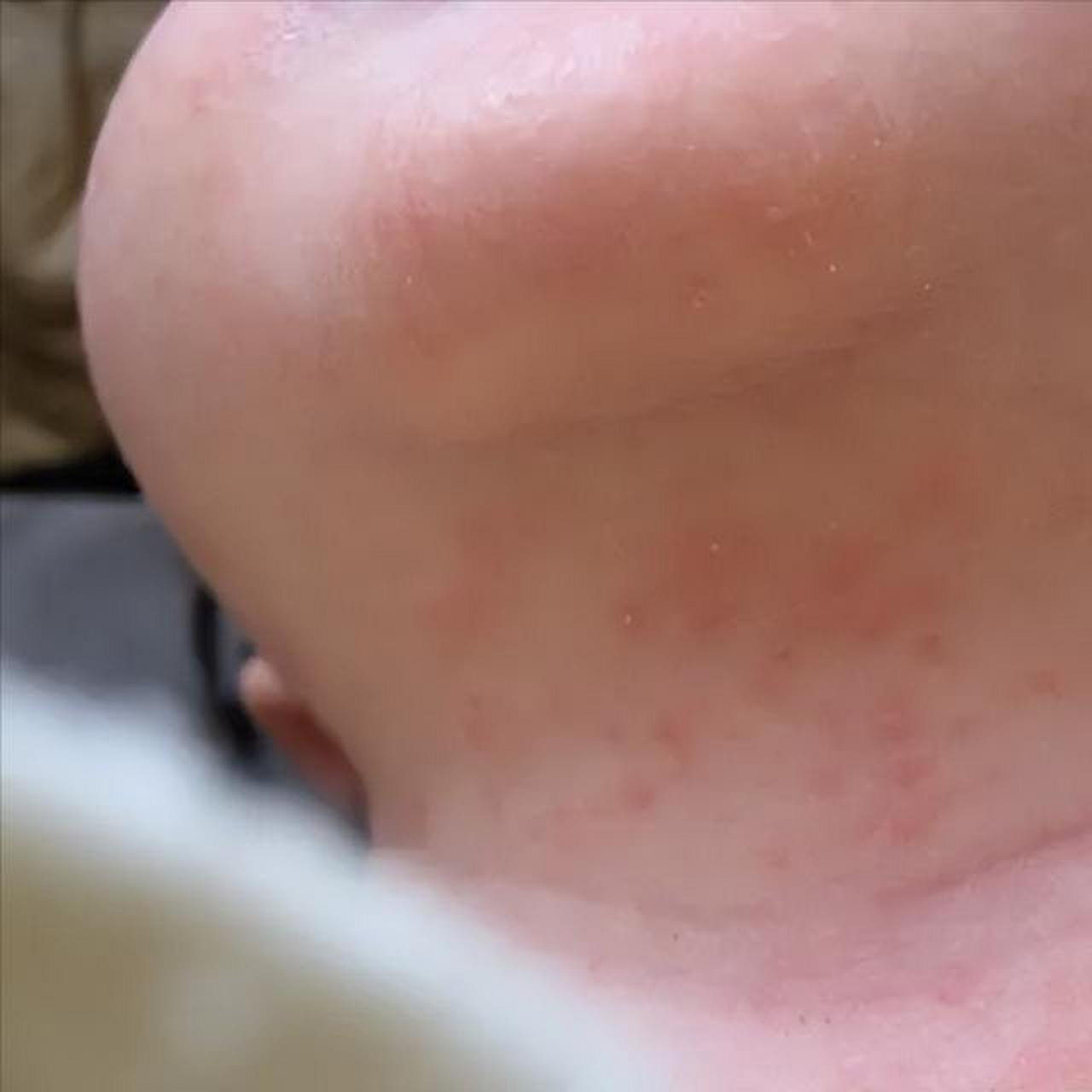宝宝脸上长奶藓了怎么办?