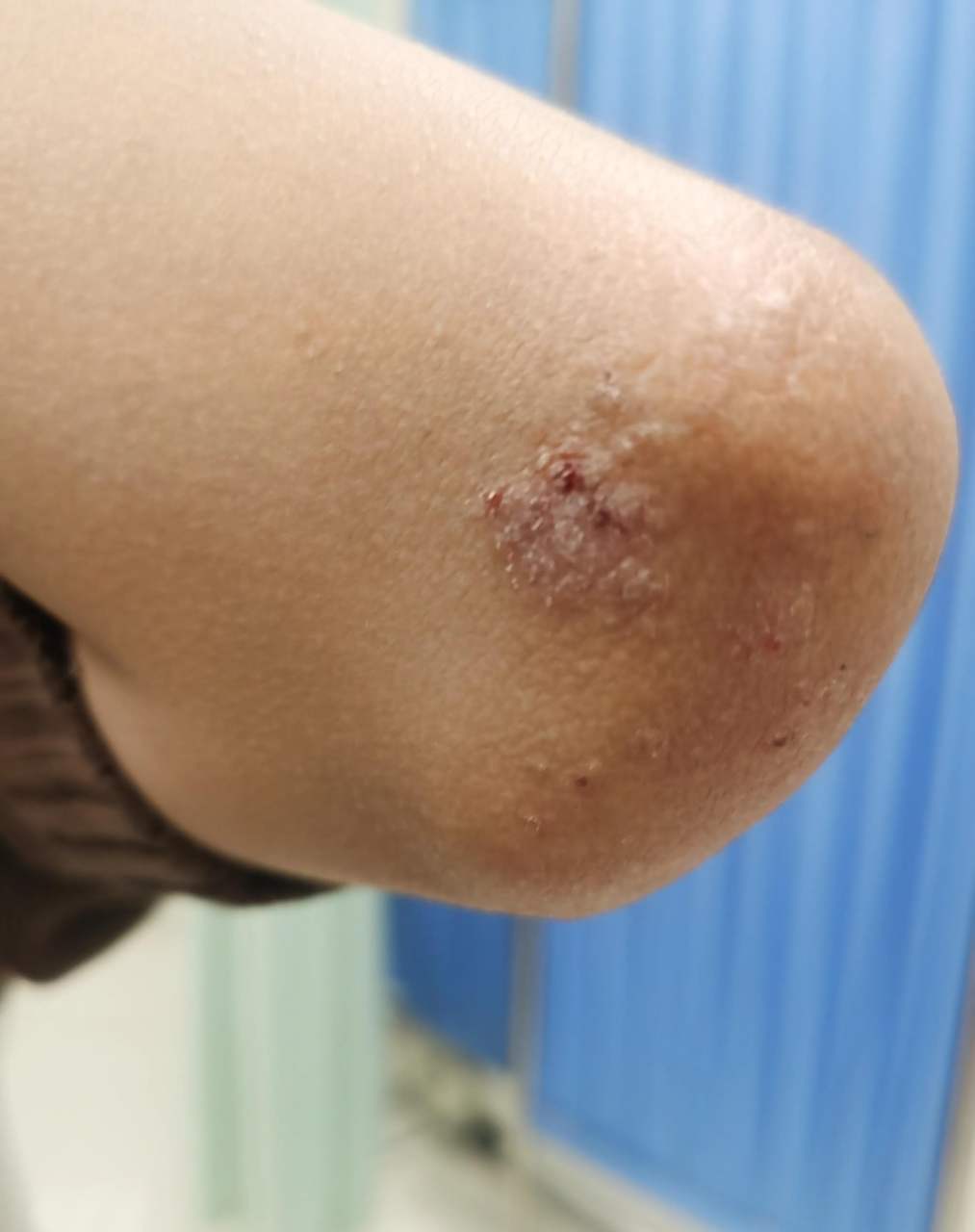 "胳膊肘有块皮肤变的不一样了,硬硬的,怎么回事儿?