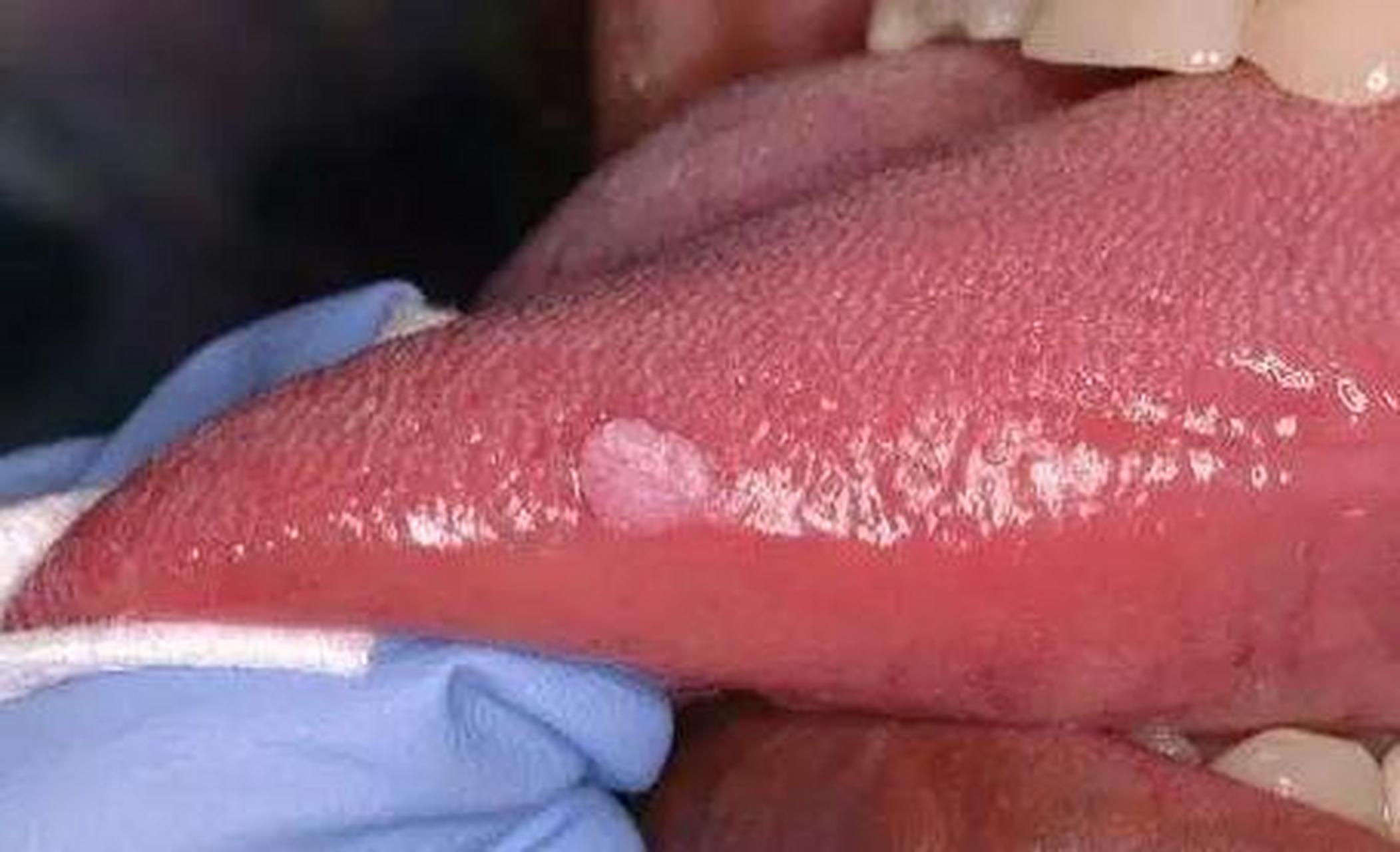 25岁的小曹,因为口腔溃疡严重到医院就诊,没想到查出