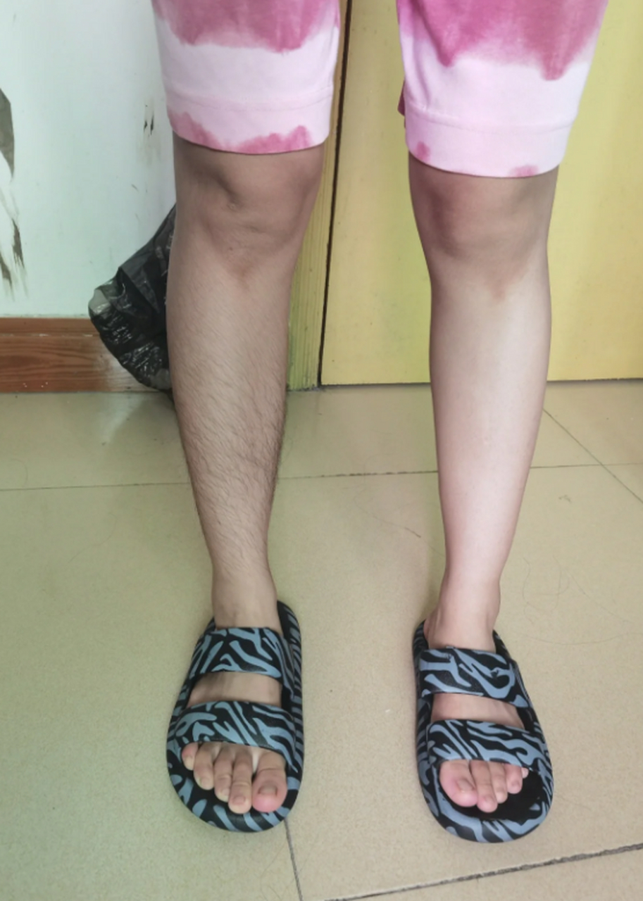 腿毛可以永久性去除吗,让我陷入了思考和探索之中.