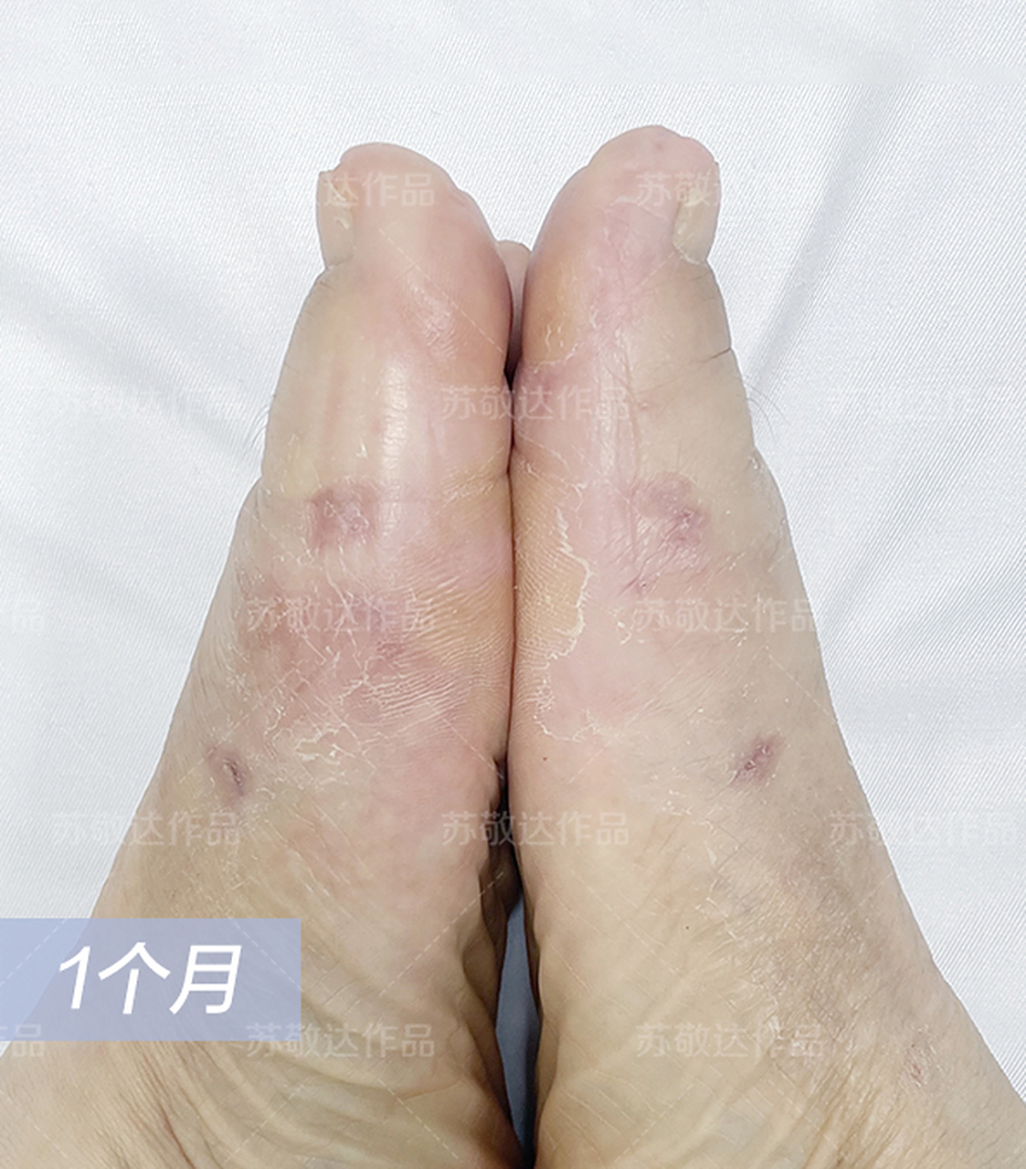 今年48了,遗传的拇外翻,一侧脚严重,骨突位置磨得发红形成拇囊炎