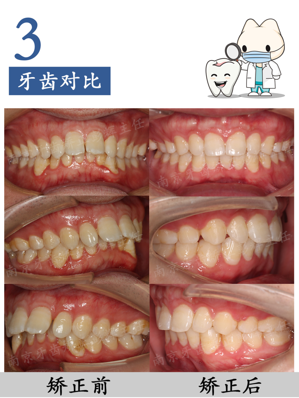 牙齿深覆合和深覆盖图片