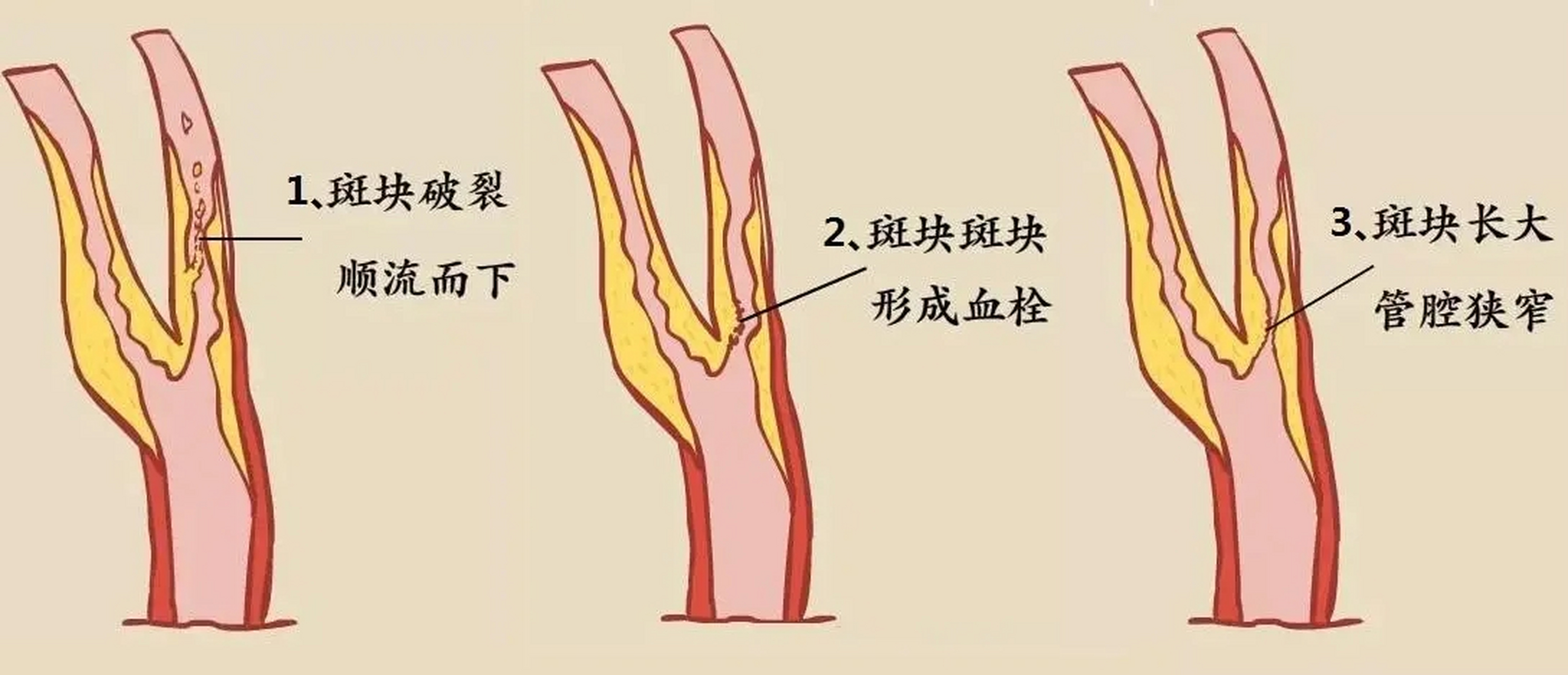 血管淤堵,心臟出現問題,中醫常用這2味藥 血管的堵塞,從中醫的角度講