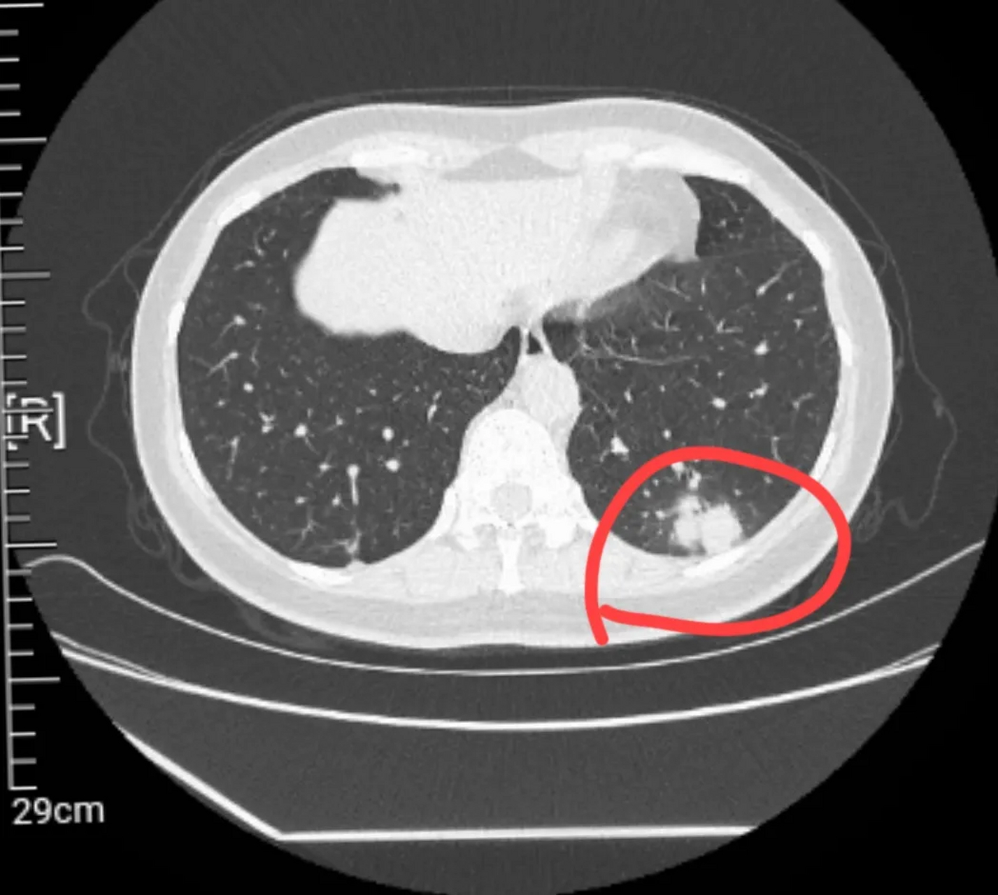 昨天一朋友打电话给我,说肺结节变成肿块了,告诉我报告是这样描述的