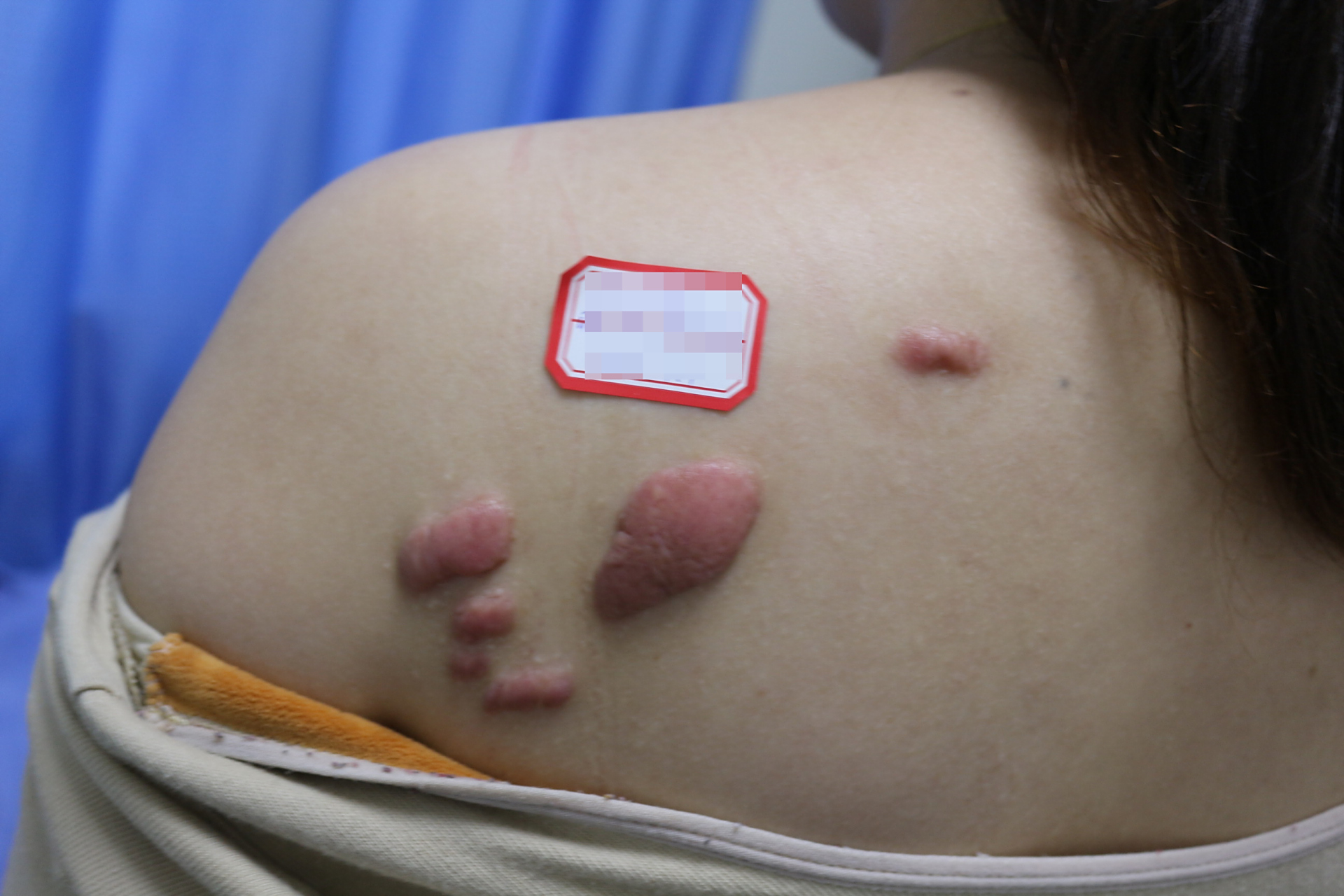 04瘢痕疙瘩瘙痒,肯定是有炎症了,炎症反应如果形成以后,可能就会