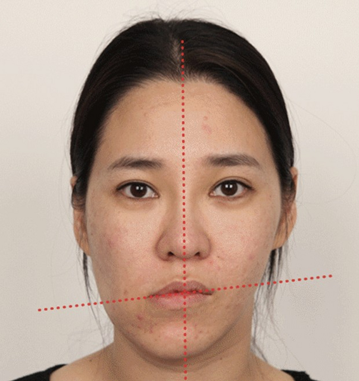 面部不对称的自我诊断法: 两边槽牙咬住一把尺子,照镜子的时候,尺子向