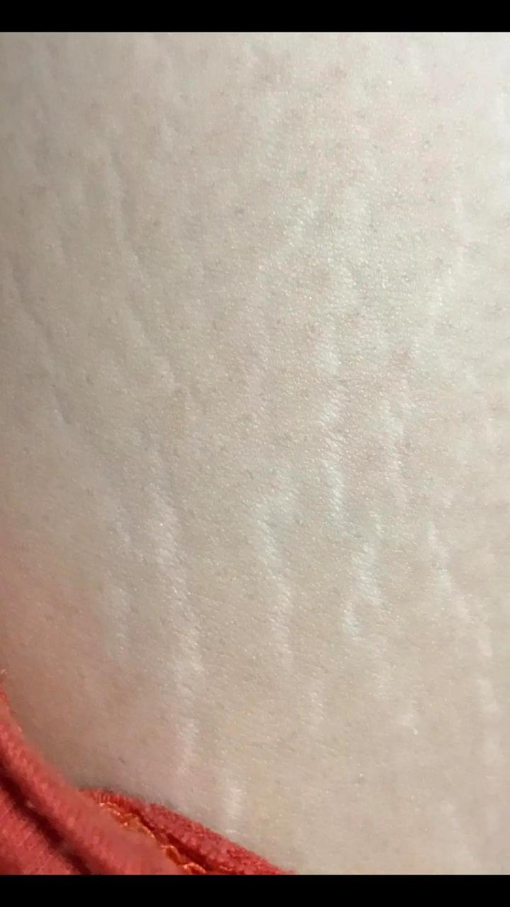 14岁晓晓肚子隆起爬满"妊娠纹",照完ct妈妈吓坏