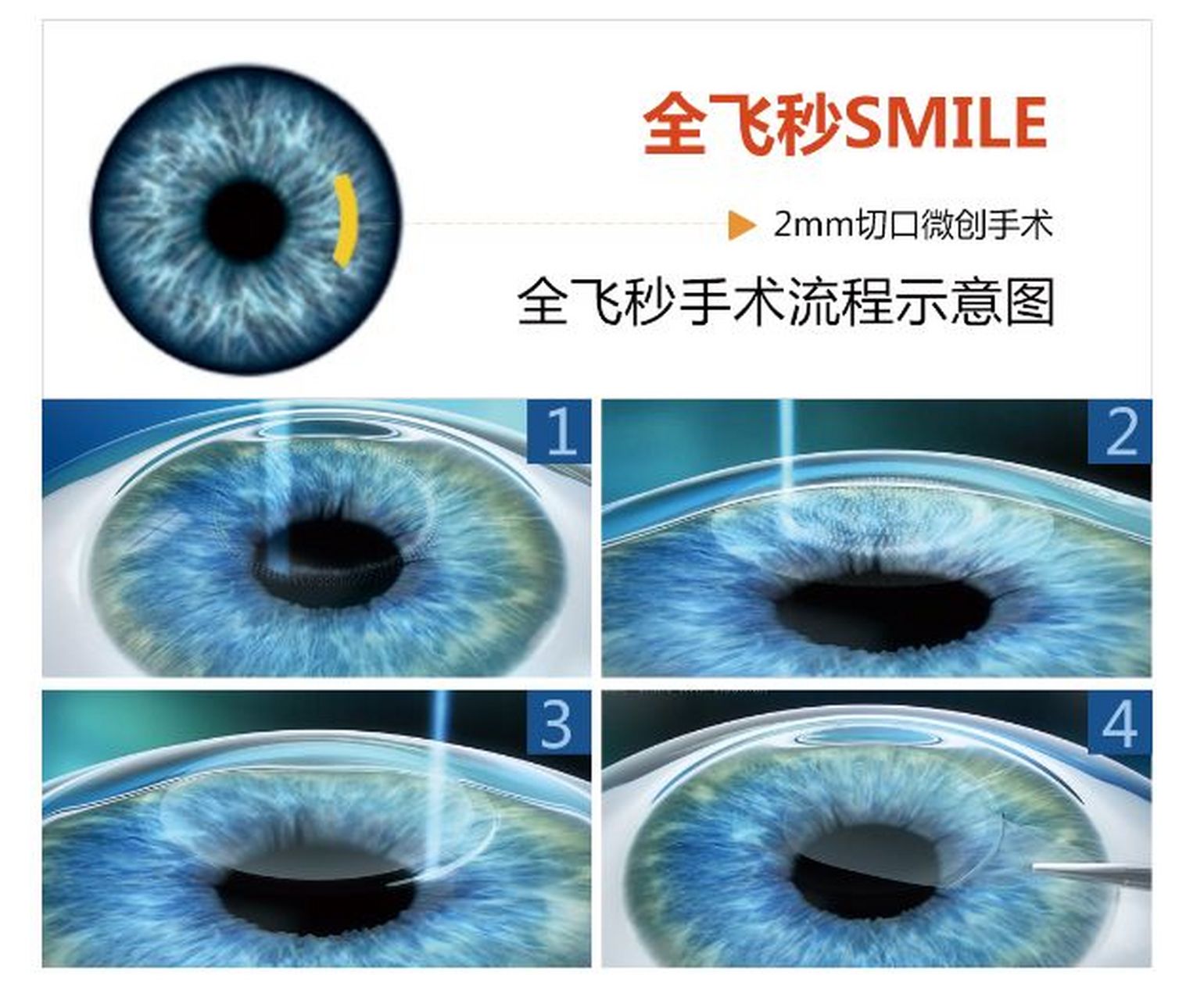 全飞秒属于微创手术,因此全飞秒手术是运动人群的较佳之选,尤其适合