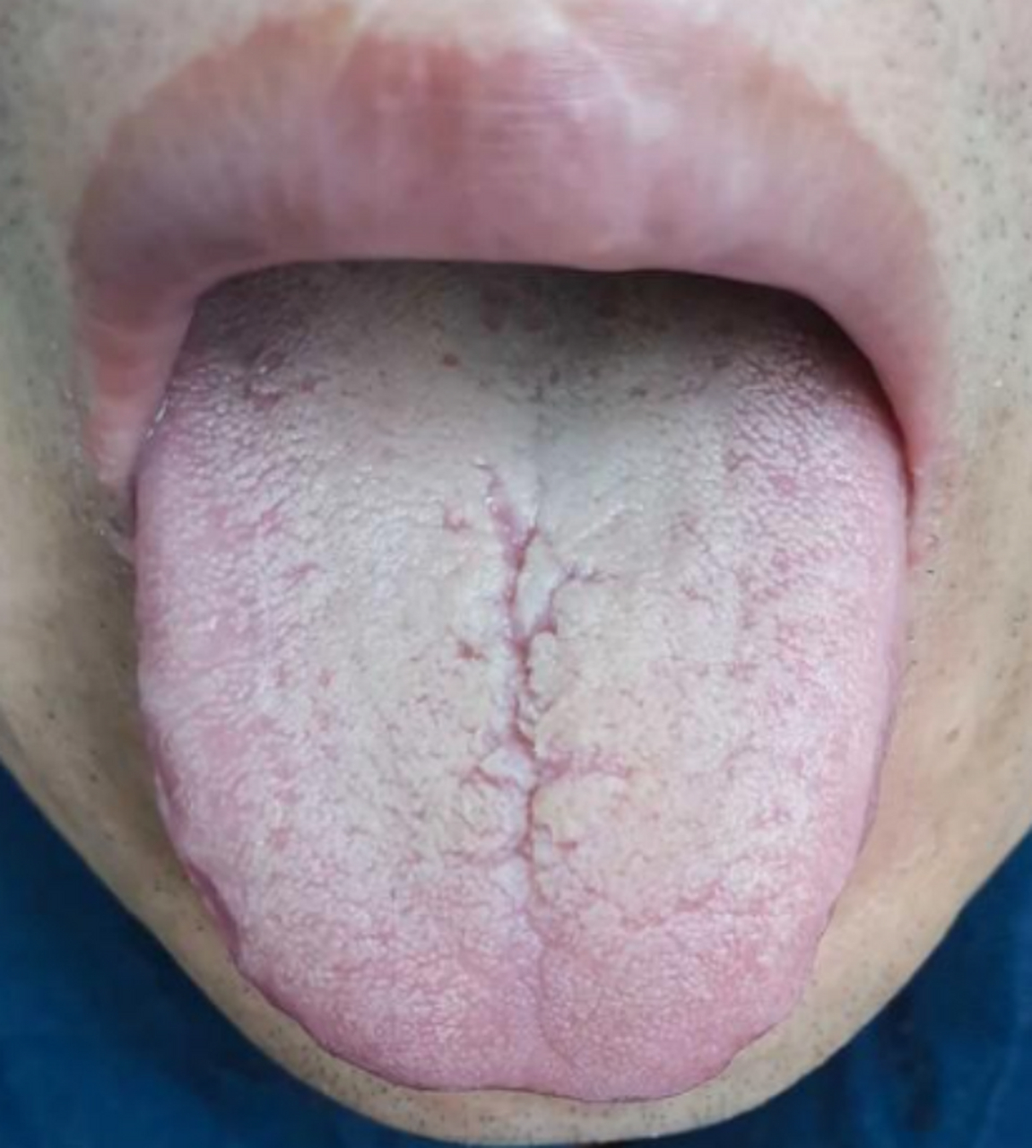 舌头有裂纹不一定是脾虚,没那么简单!