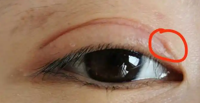 为什么埋线后起疙瘩