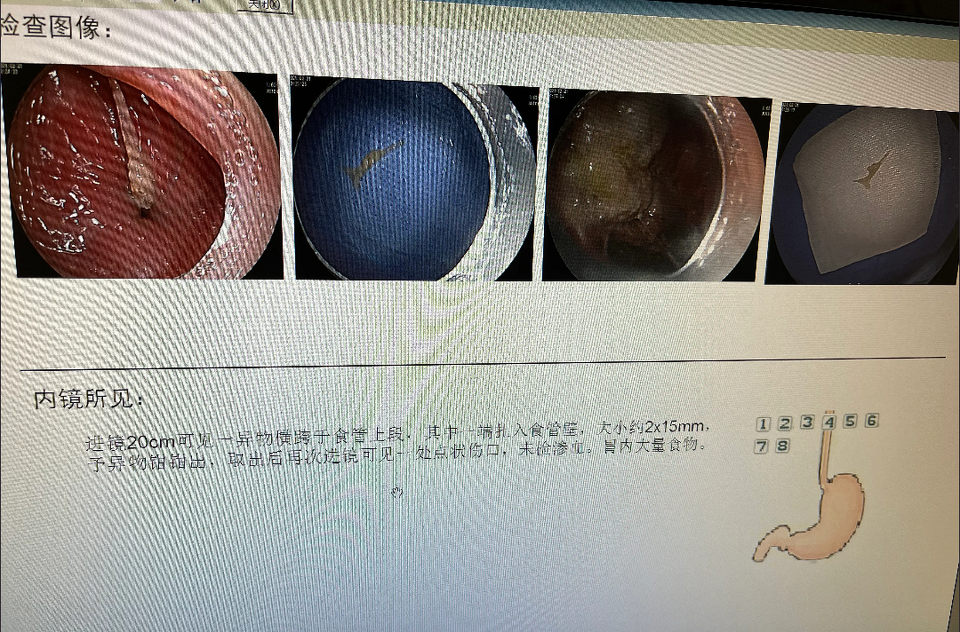 小小鱼刺就准准的扎在食管壁上不上不下,晚上急诊加班取出来!