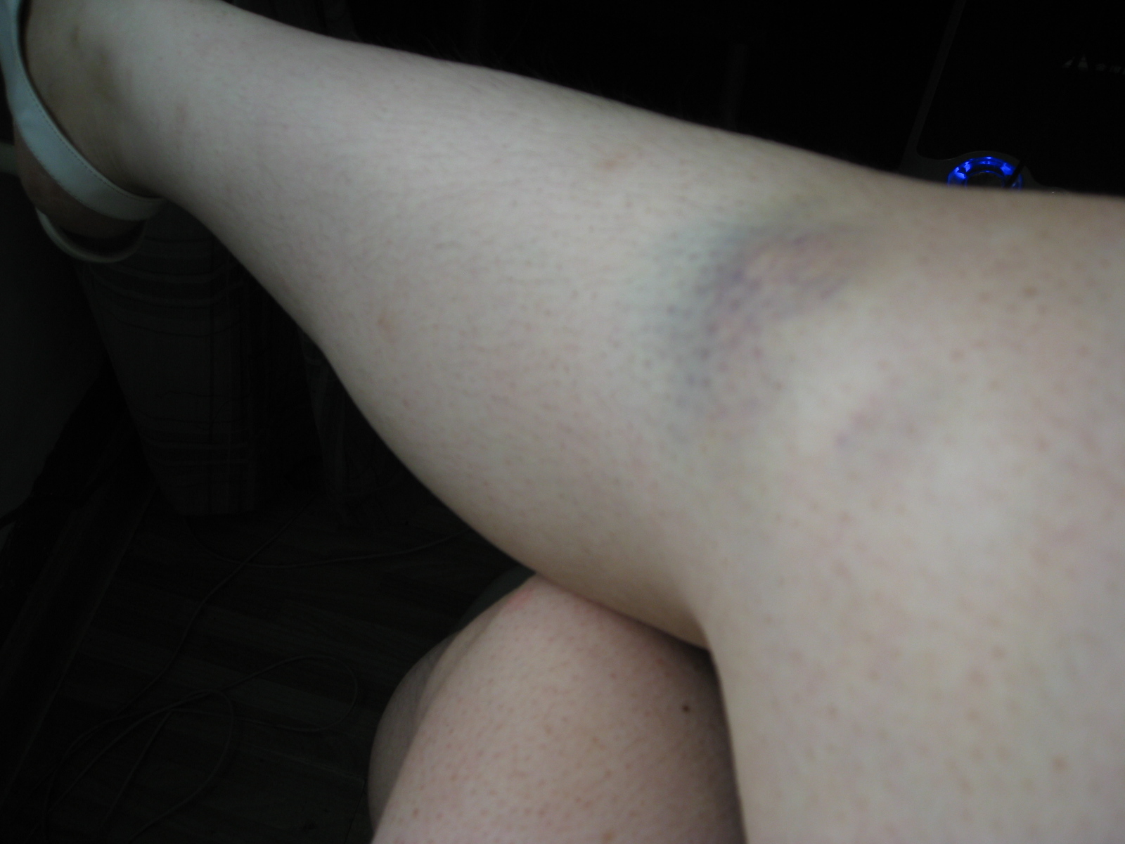 我发现我女朋友身上总是有很多淤青,我问她怎么回事,她总是说可能不