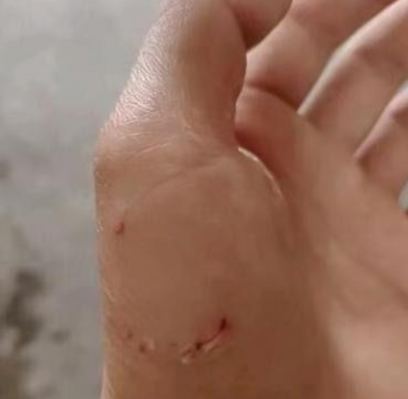 这样的伤口需要打狂犬疫苗吗