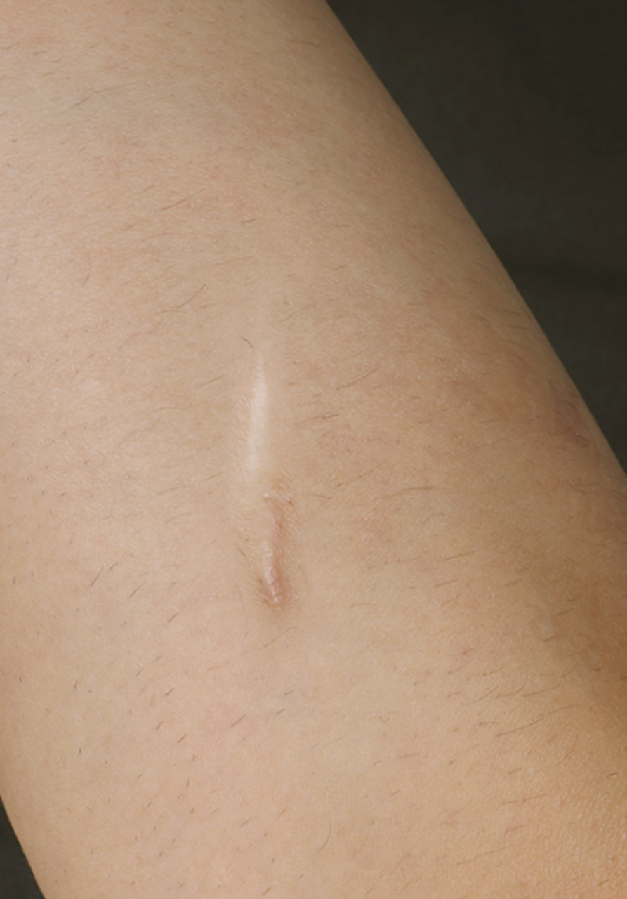 手术祛疤# 凸起疤痕增生如何消除?