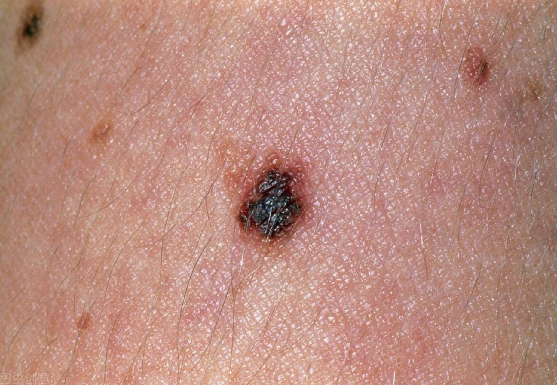 婆婆说这颗黑痣很久了,应该没事.但刘女士很担心,带她去检查.