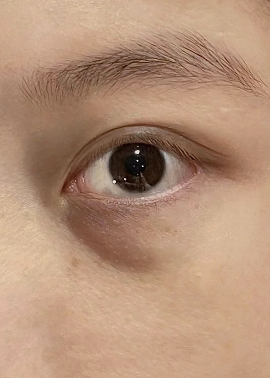 眼袋松弛是一种常见的眼部问题,给人们带来不少困扰.
