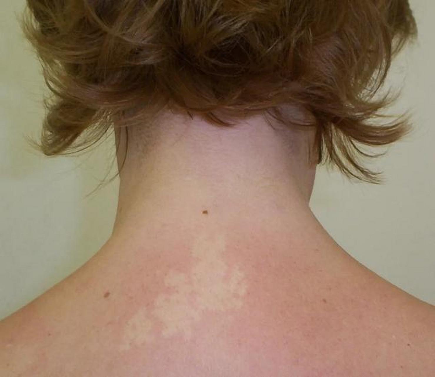 无色素痣是什么皮肤病 无色素痣是色素减退斑,主要是与黑素细胞发育