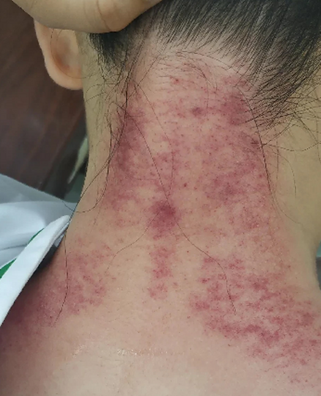 脖子刮痧,一般以颈椎后面为主,刮拭中间和两侧,又叫"颈后三线".