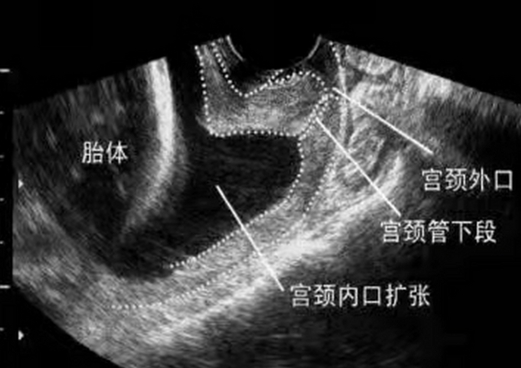 不过,适当的活动也是有益的,可以帮助身体更快地恢复.#宫颈环扎
