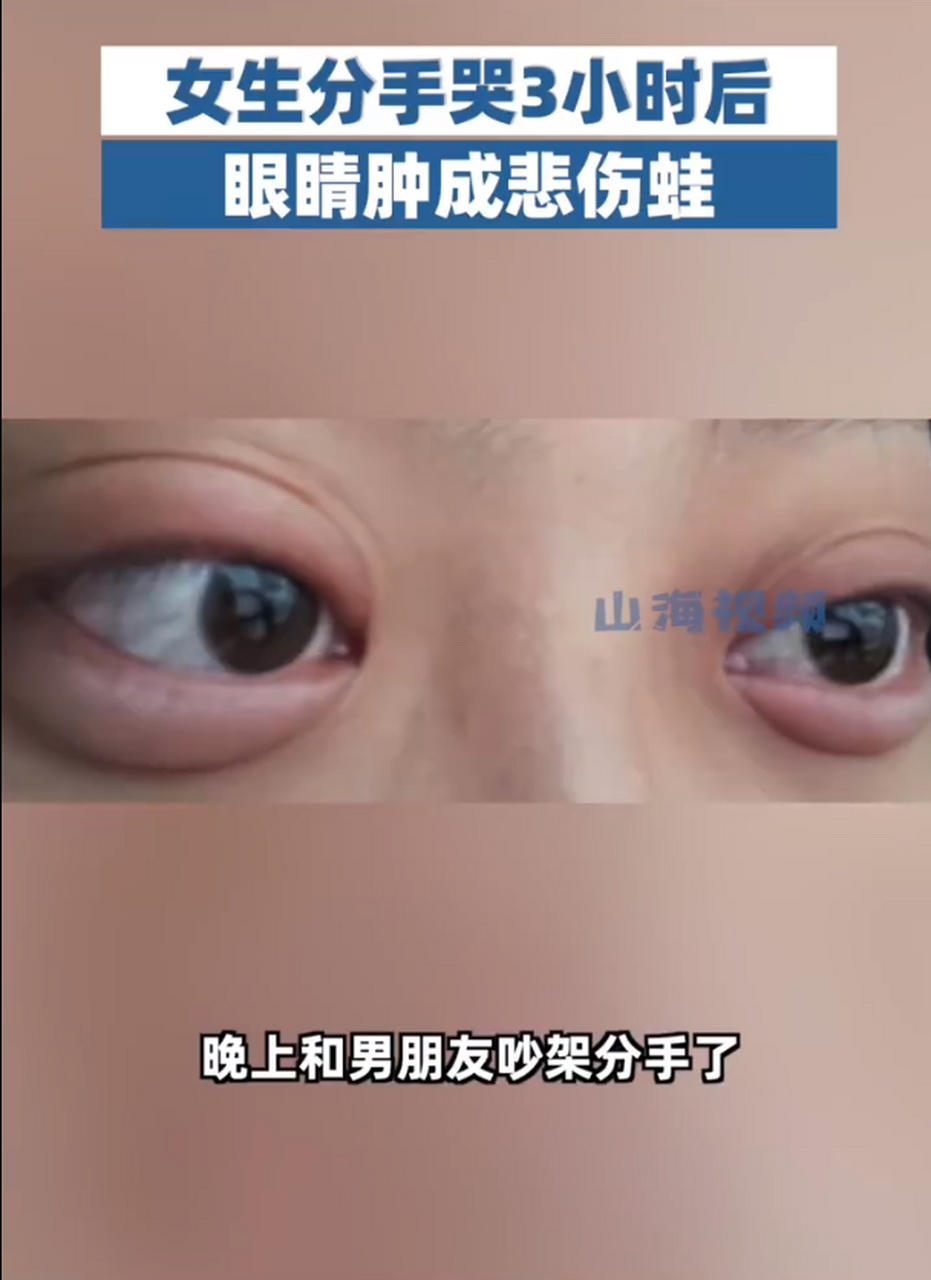 为什么哭了眼睛会肿