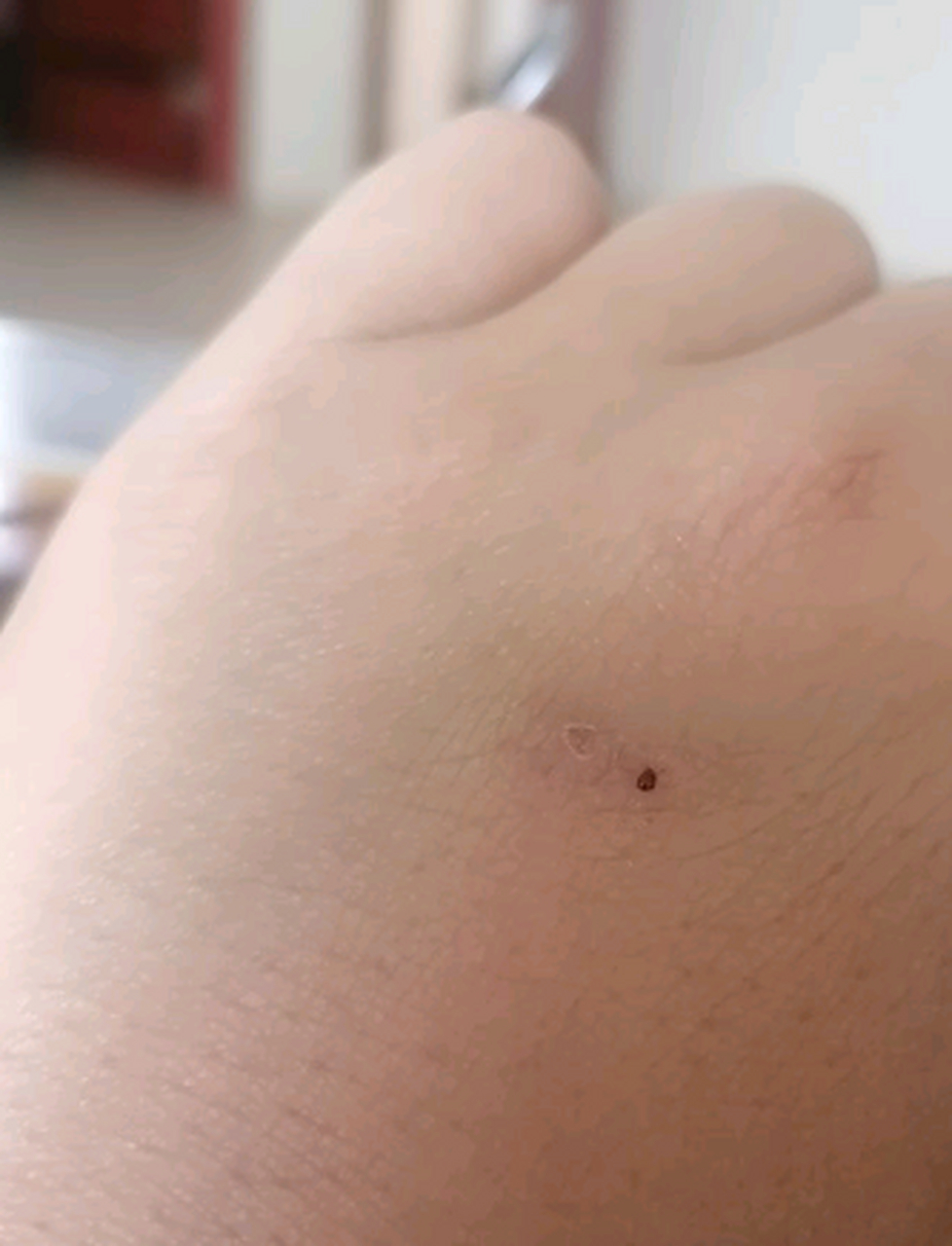 出去钓鱼被蛇咬了,伤口已经愈合了,但为什么手一直肿着